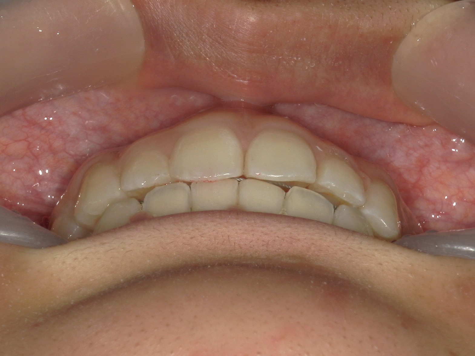 プチワイヤー矯正　症例（54）