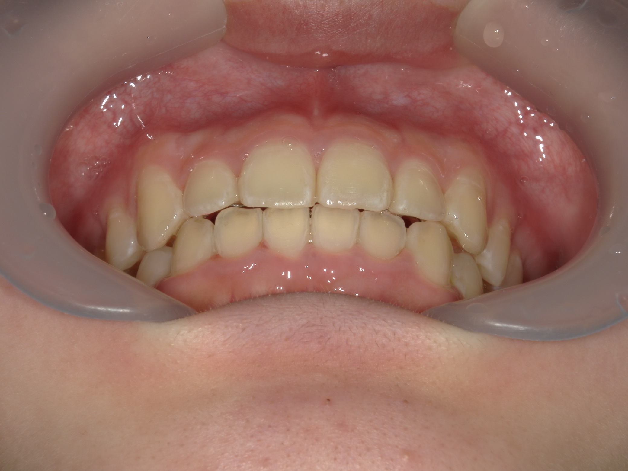 プチワイヤー矯正　症例（55）