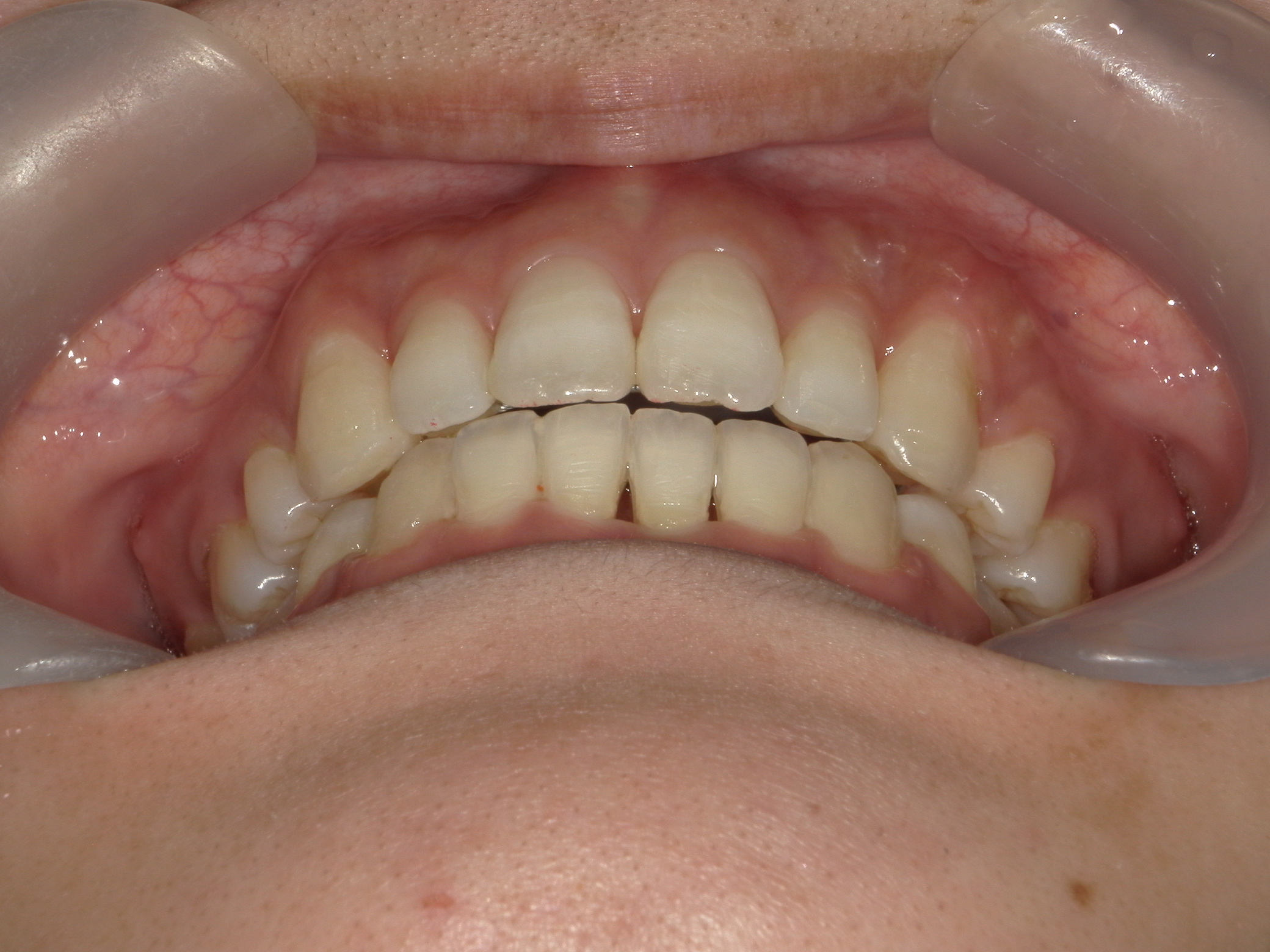 全顎ワイヤー矯正　症例（75）