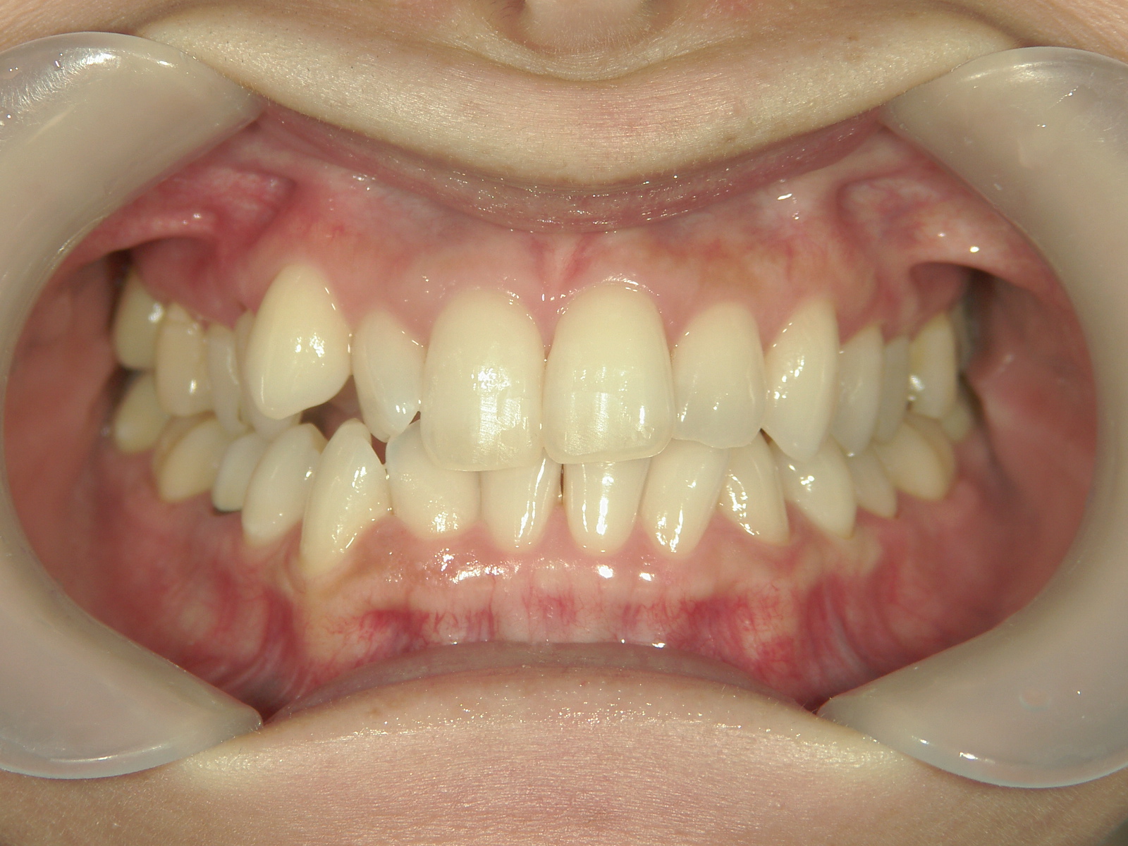 プチワイヤー矯正　症例（51）