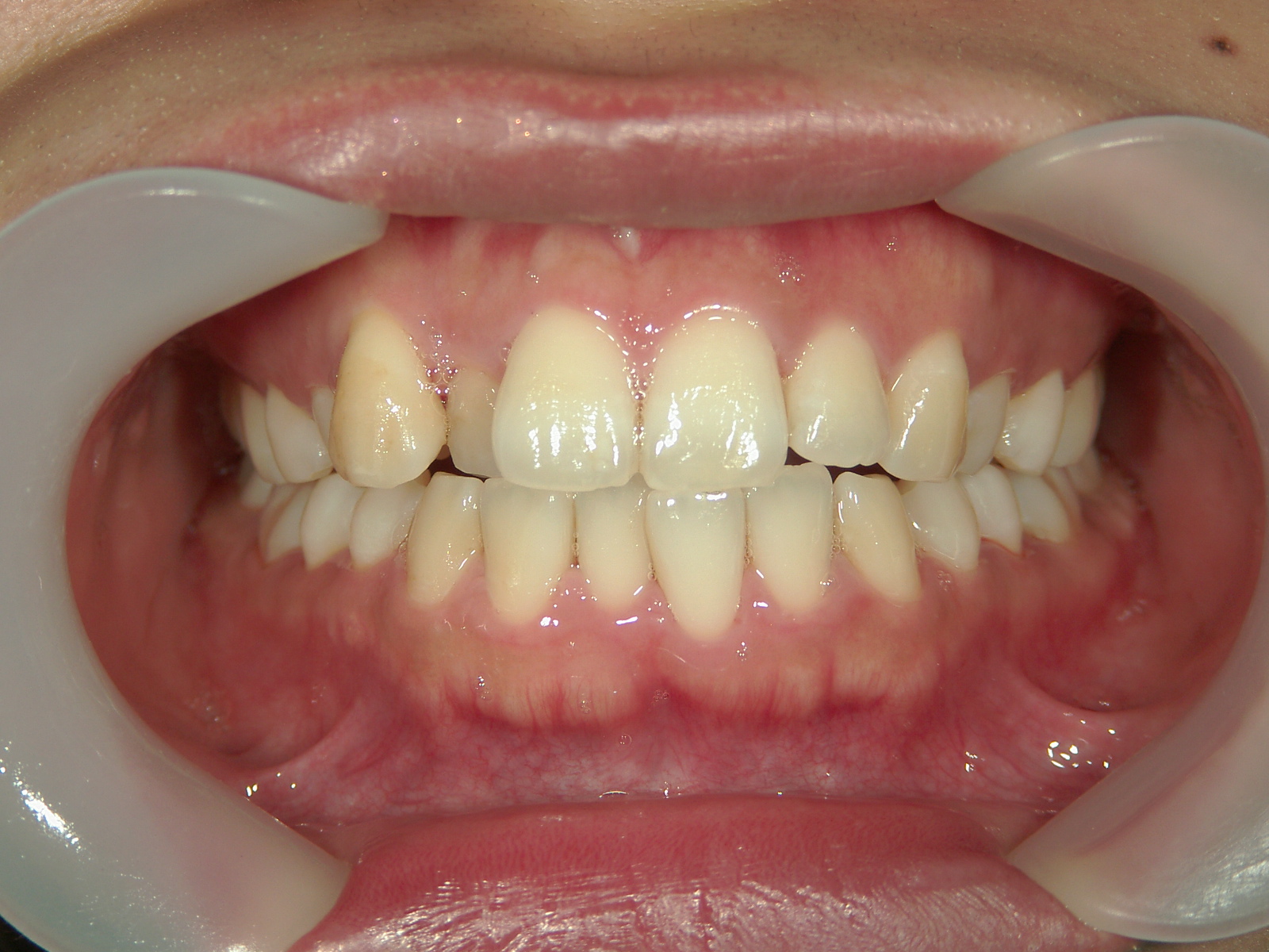 プチワイヤー矯正　症例（56）