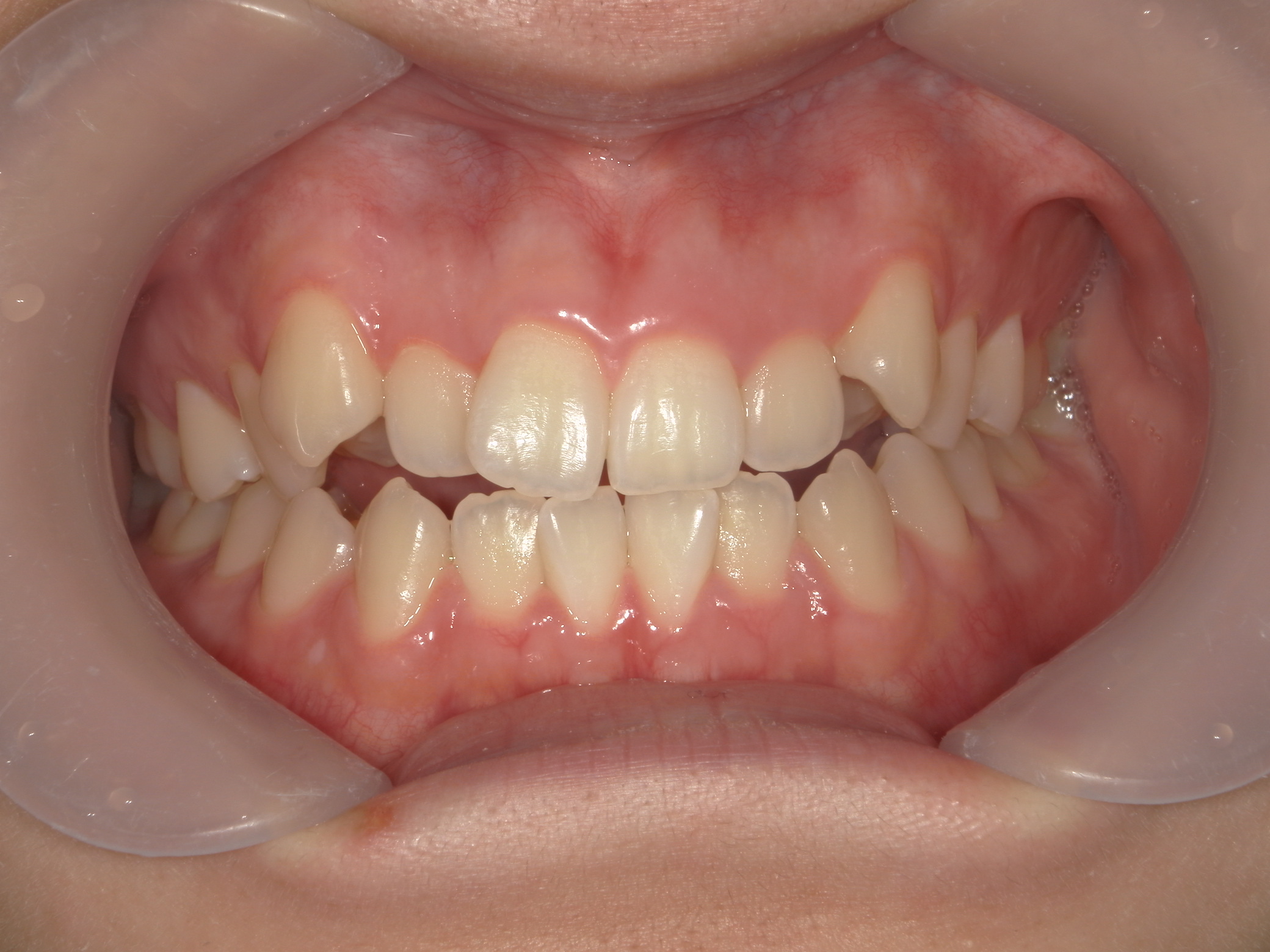 プチワイヤー矯正　症例（57）