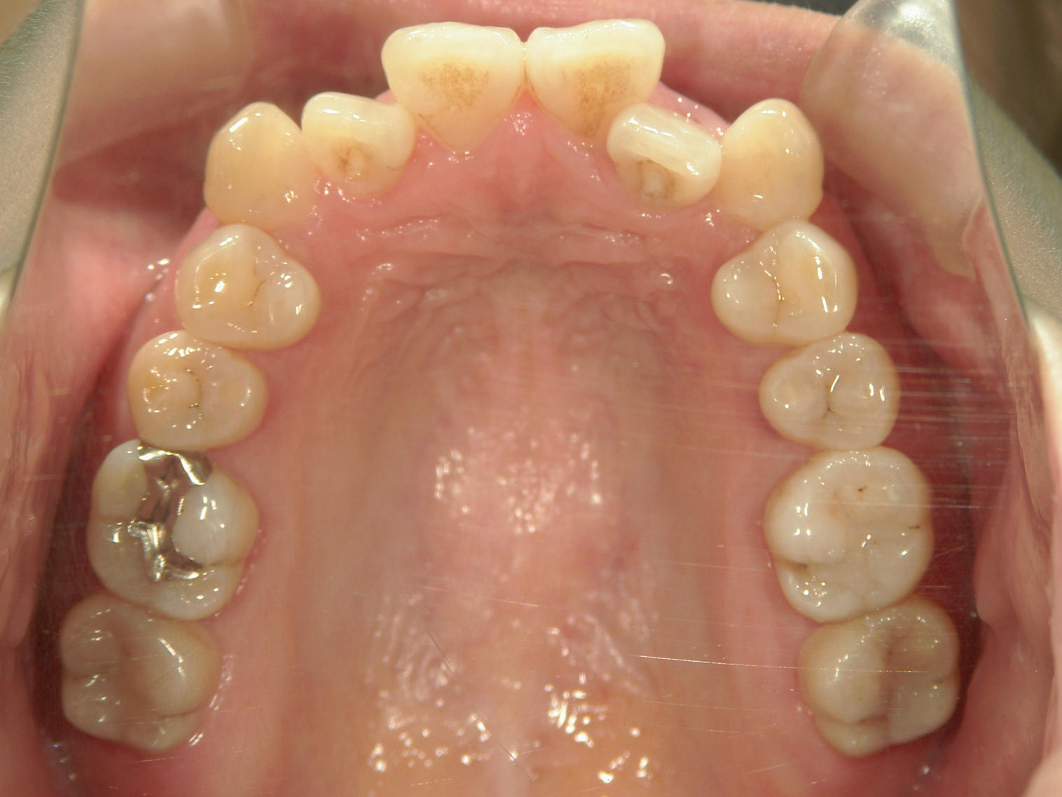 プチワイヤー矯正　症例（53）