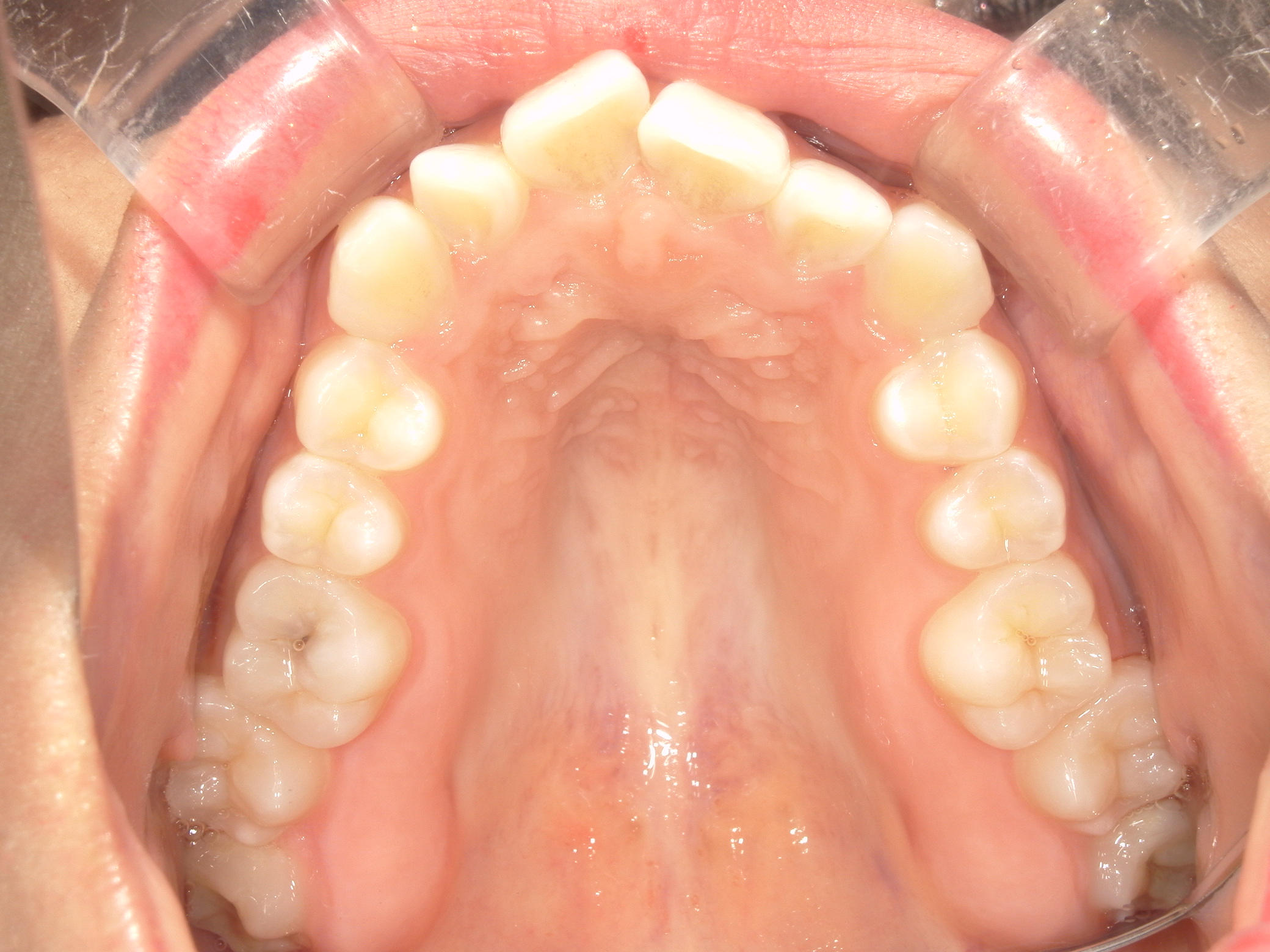 プチワイヤー矯正　症例（54）