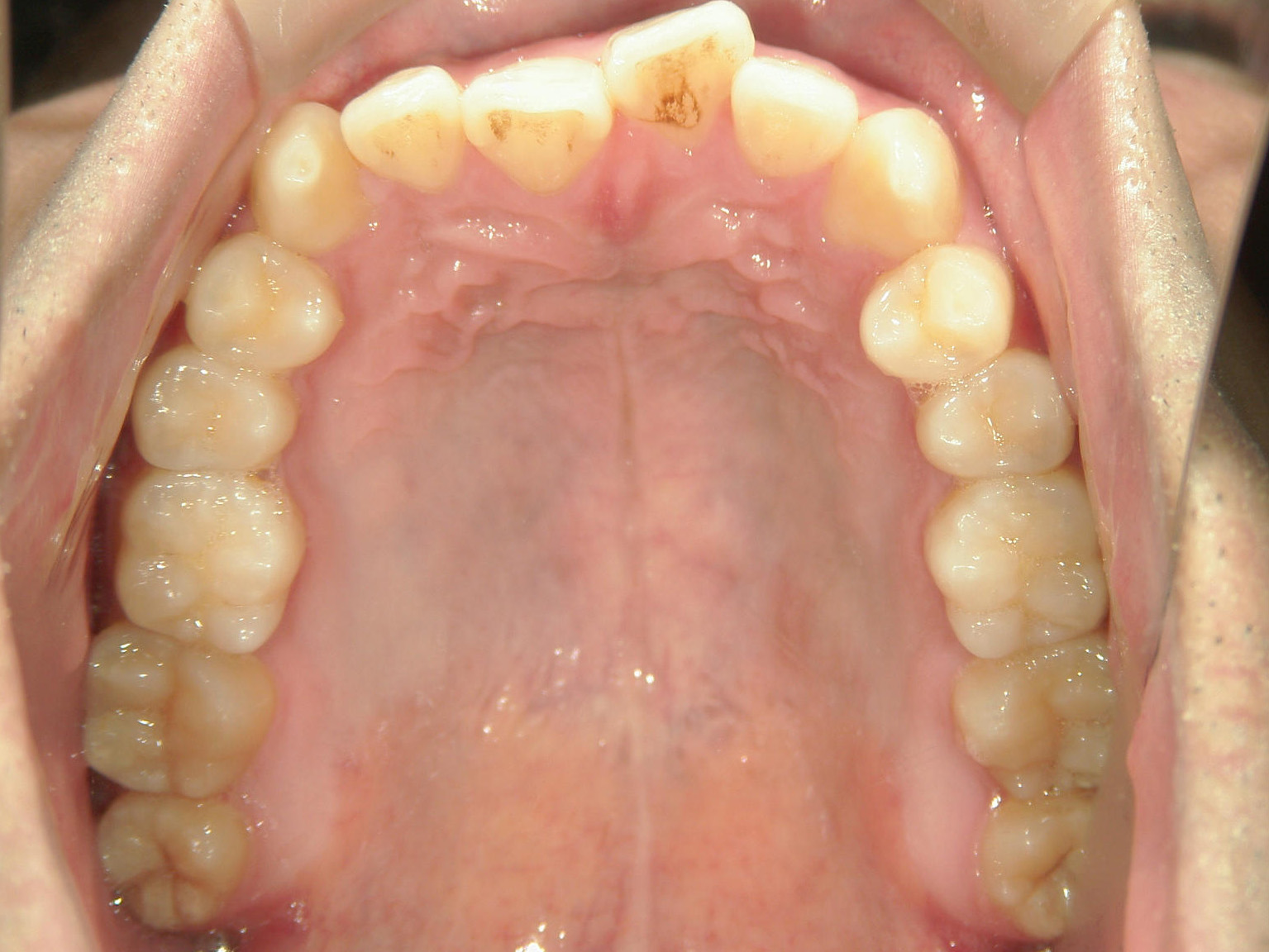 インビザライン矯正　症例（29）