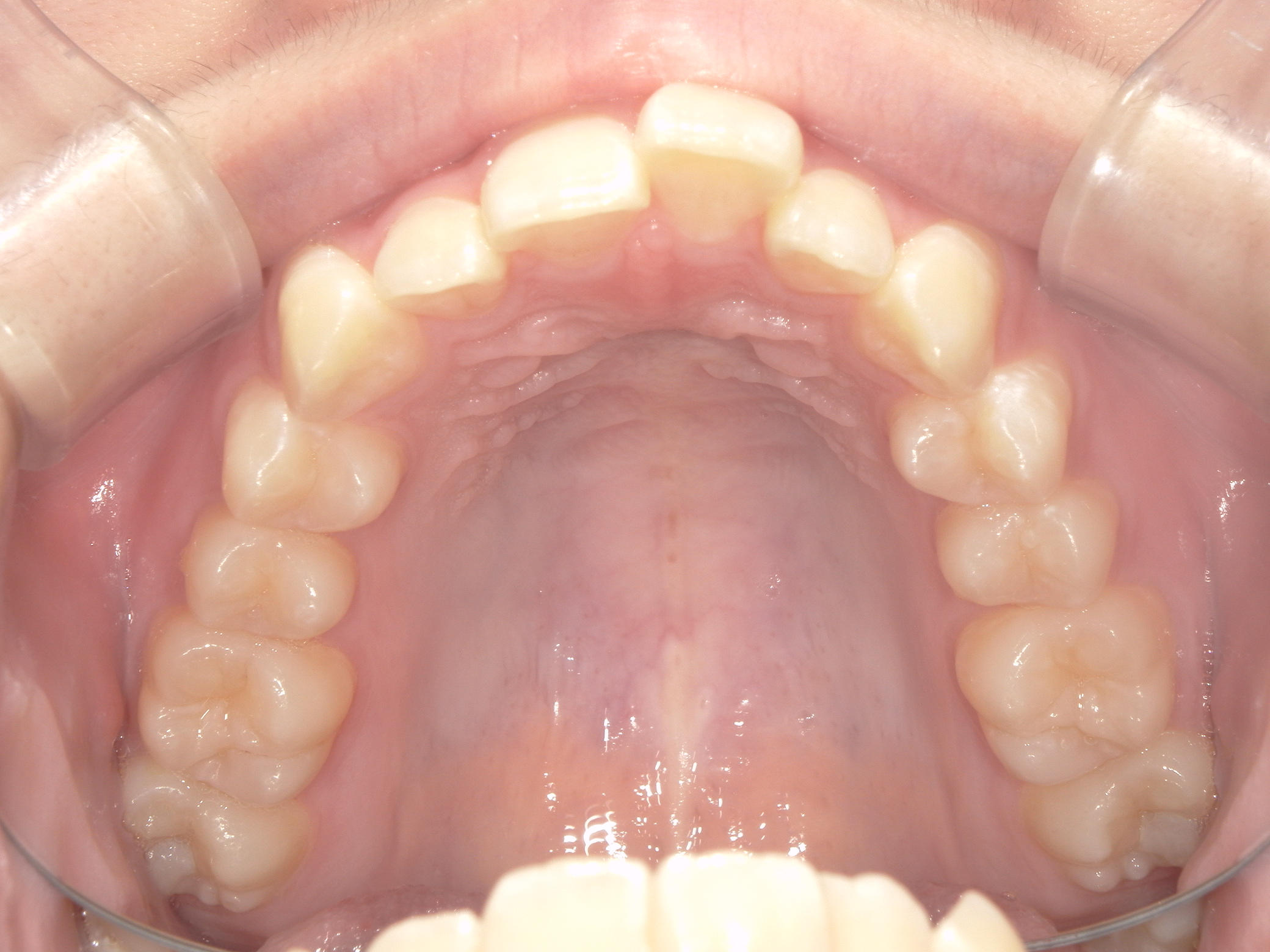 プチワイヤー矯正　症例（55）