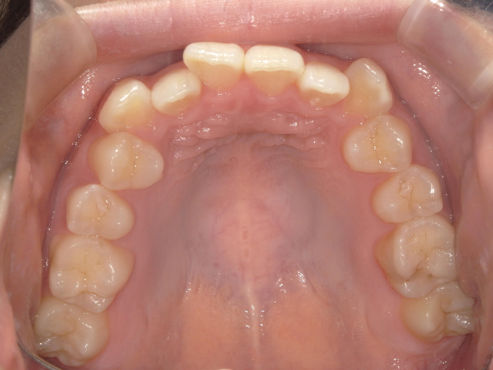 プチワイヤー矯正　症例（57）
