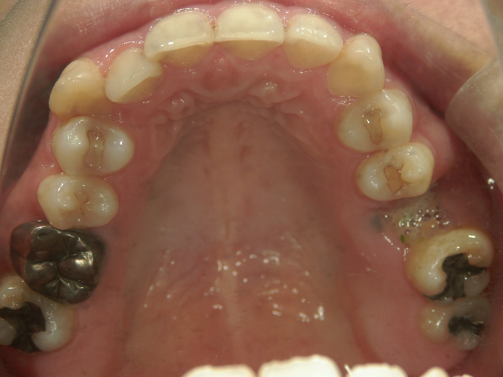 全顎ワイヤー矯正　症例（76）