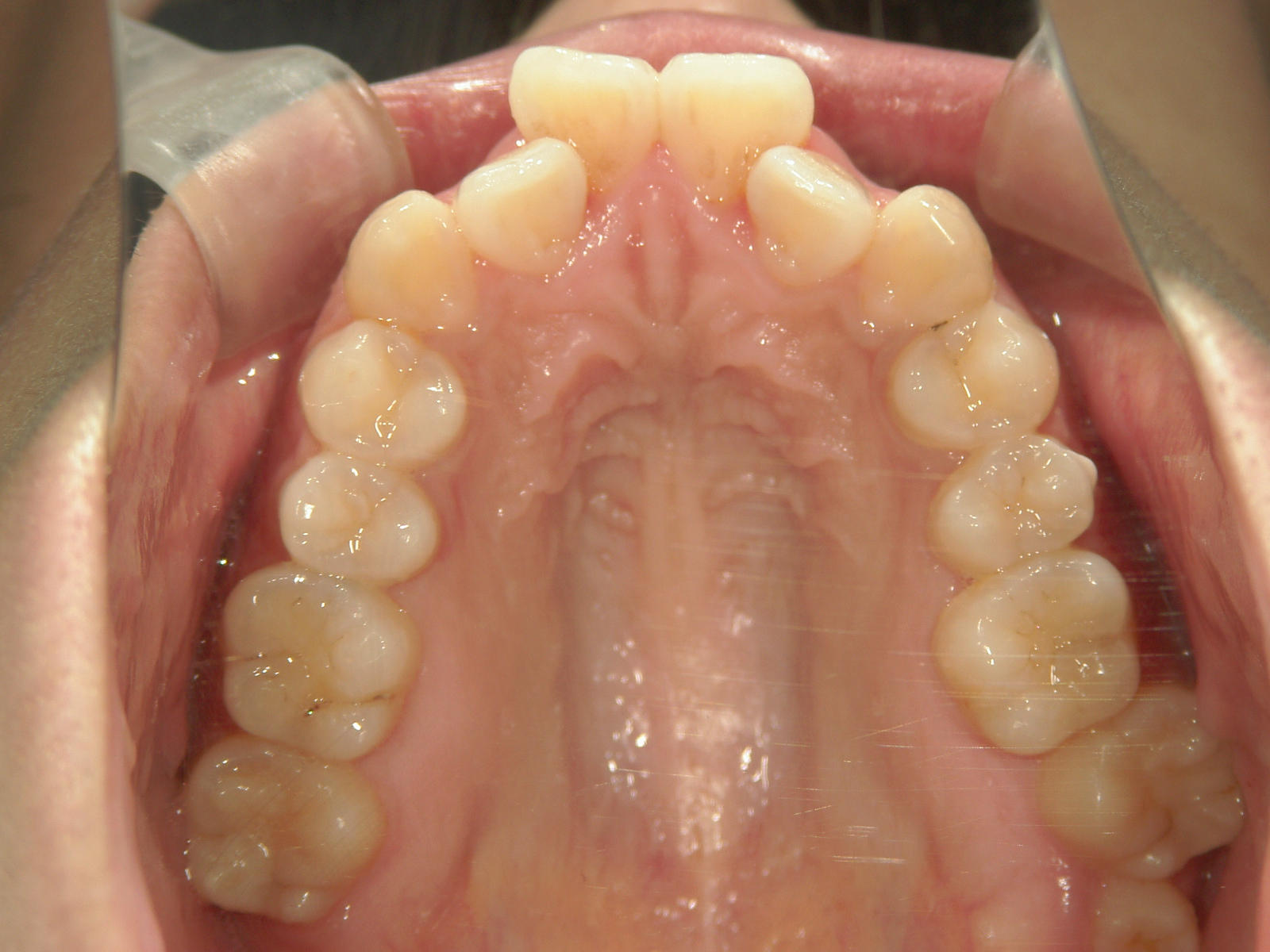 全顎ワイヤー矯正　症例（78）