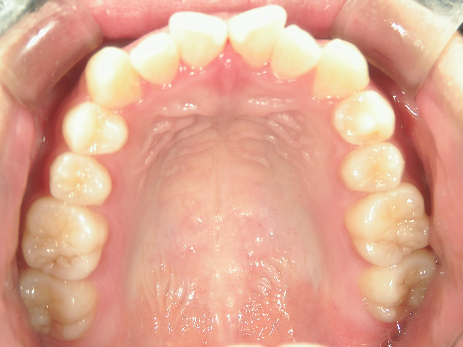 インビザライン(ライト)矯正　症例（28）