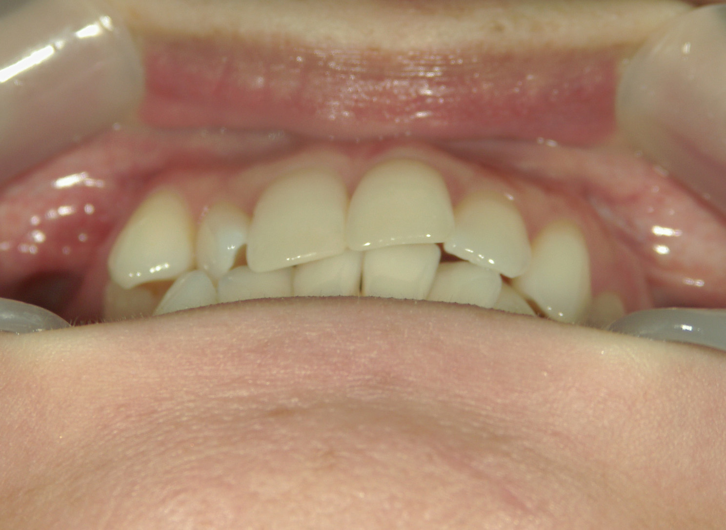 プチワイヤー矯正　症例（51）