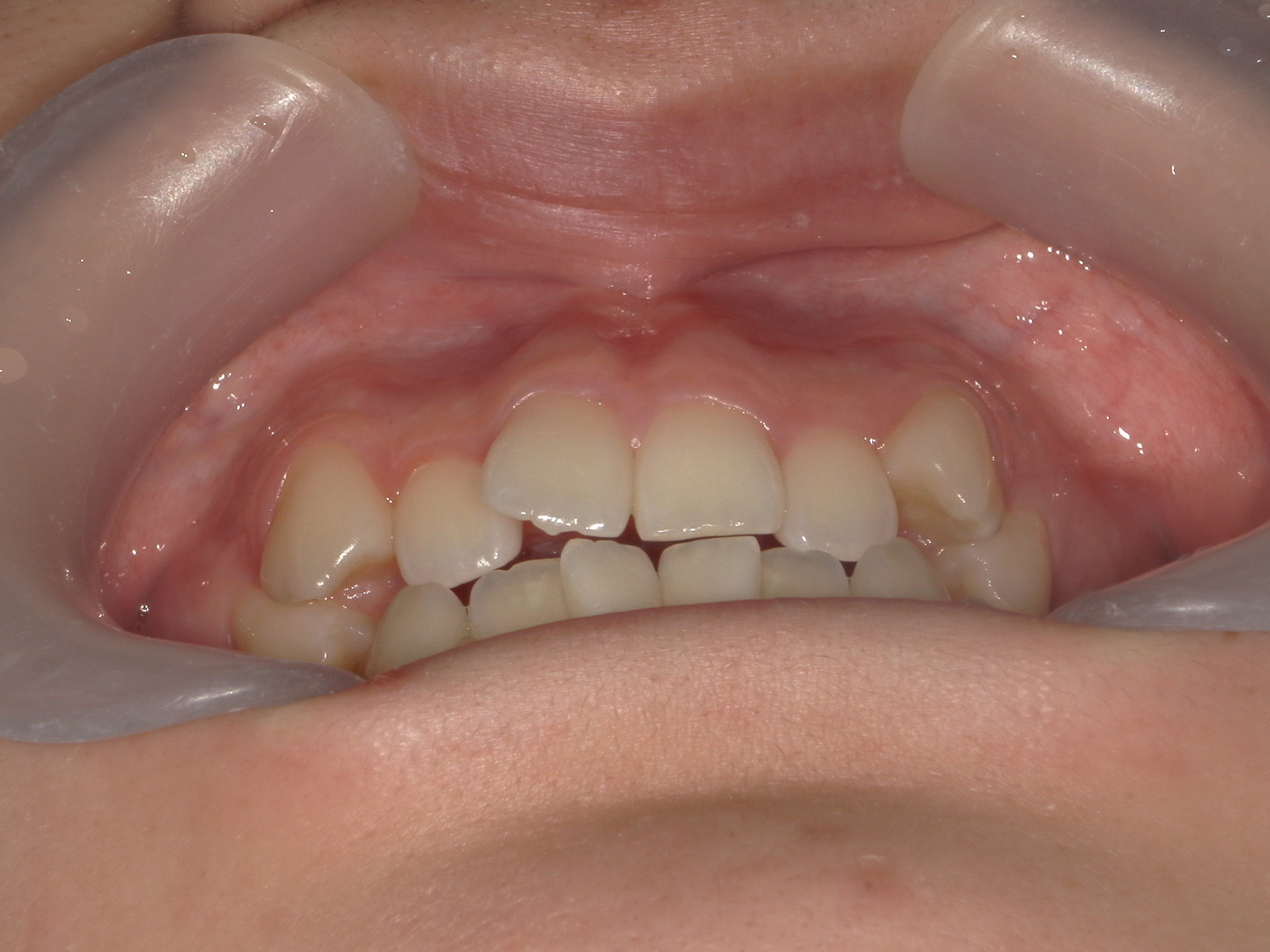 プチワイヤー矯正　症例（57）