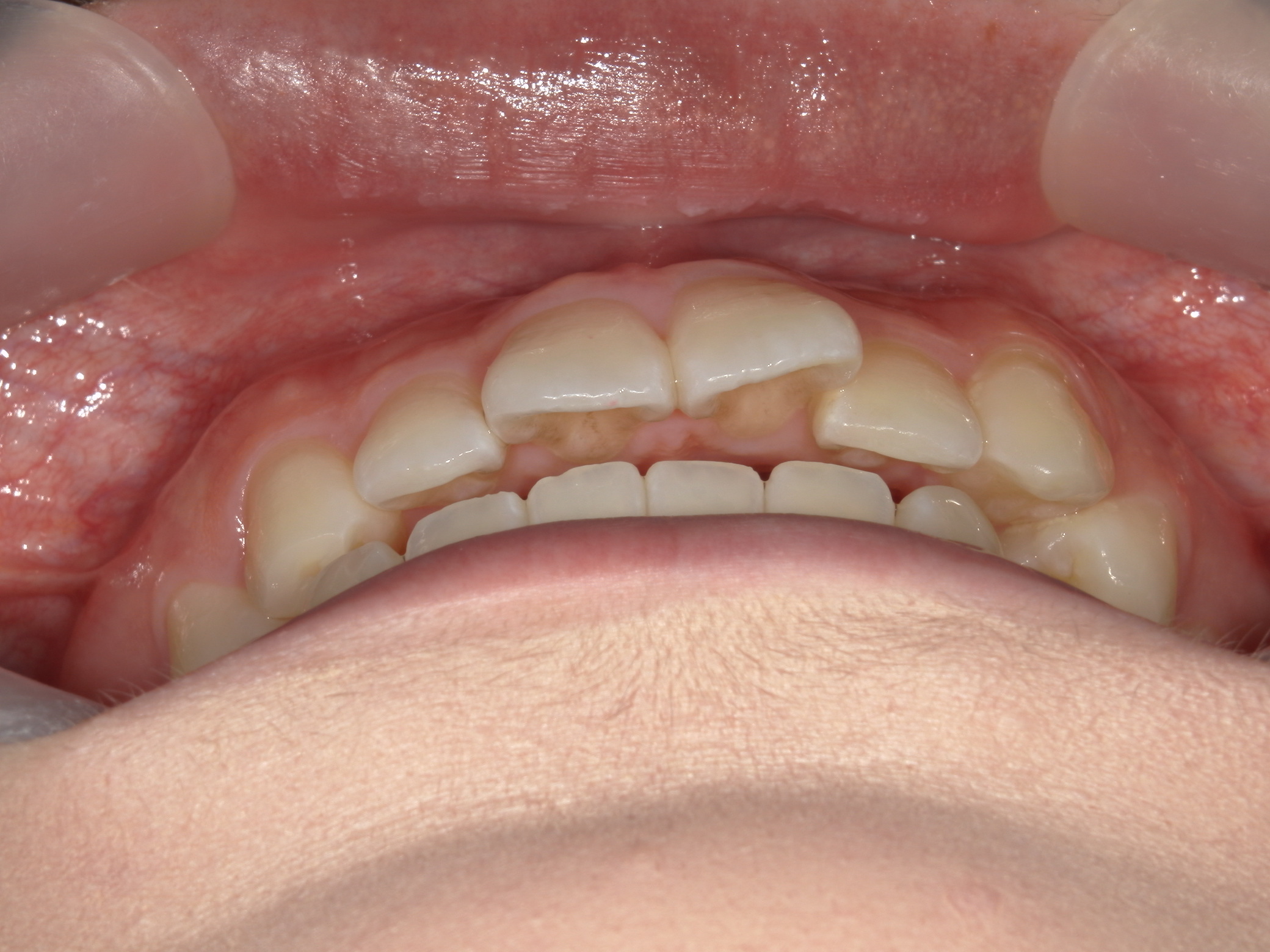 インビザライン矯正(㊤ライト)症例（27）