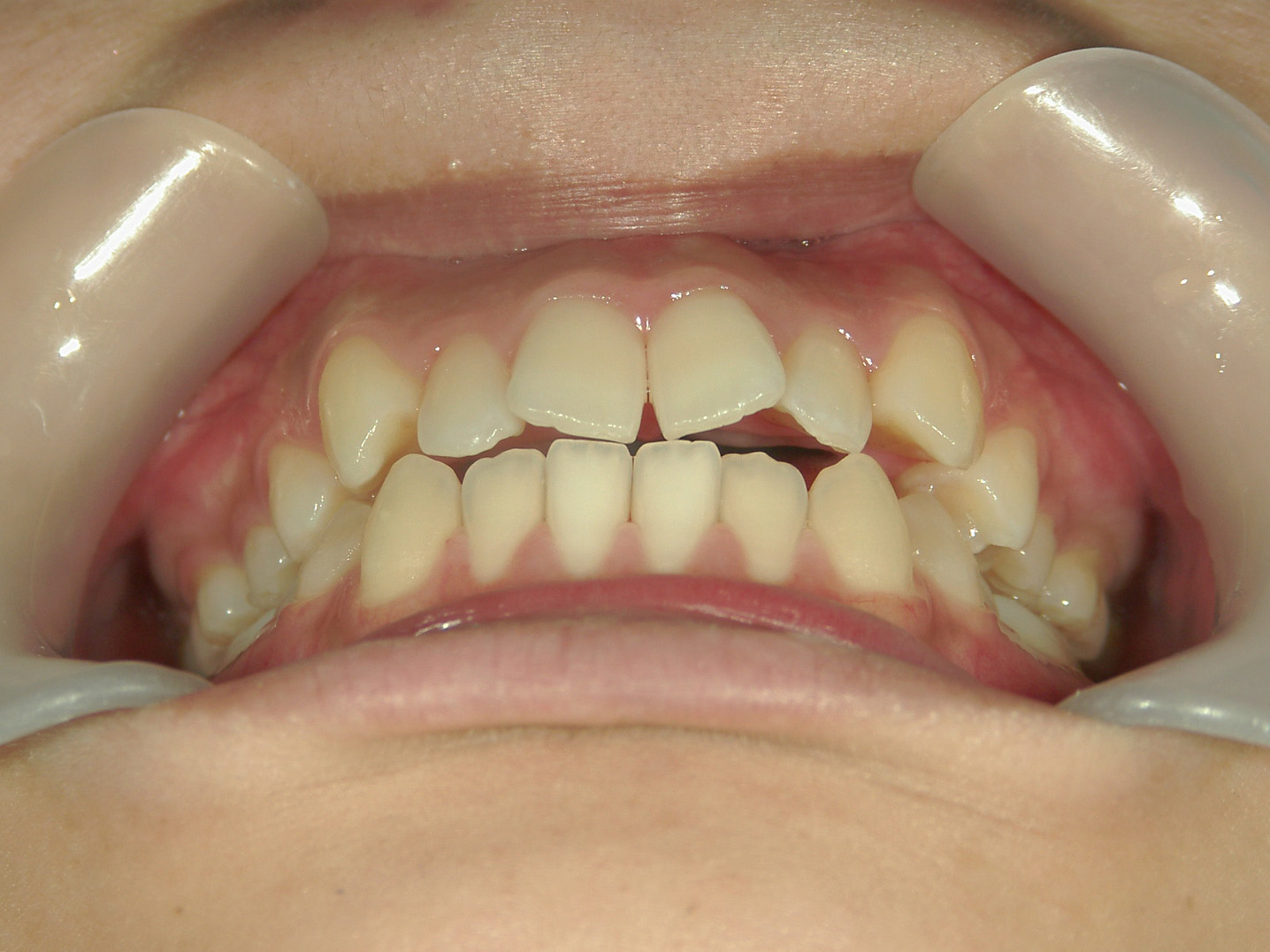 インビザライン(ライト)矯正　症例（28）