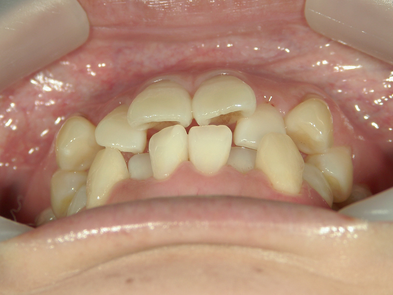 プチワイヤー矯正　症例（53）