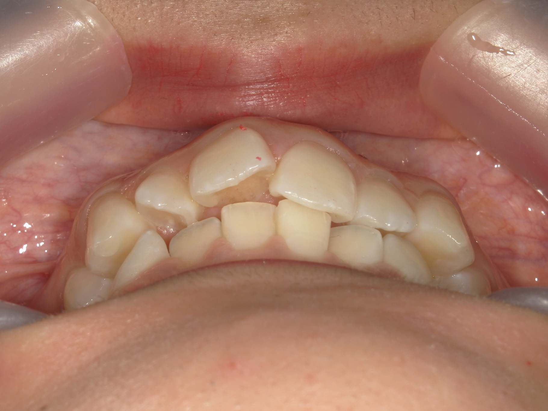 プチワイヤー矯正　症例（54）