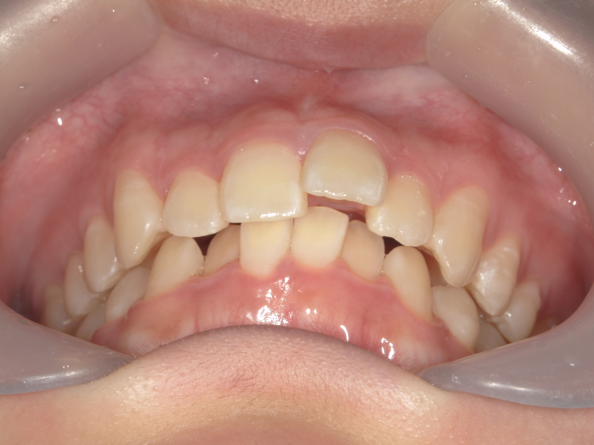 プチワイヤー矯正　症例（55）