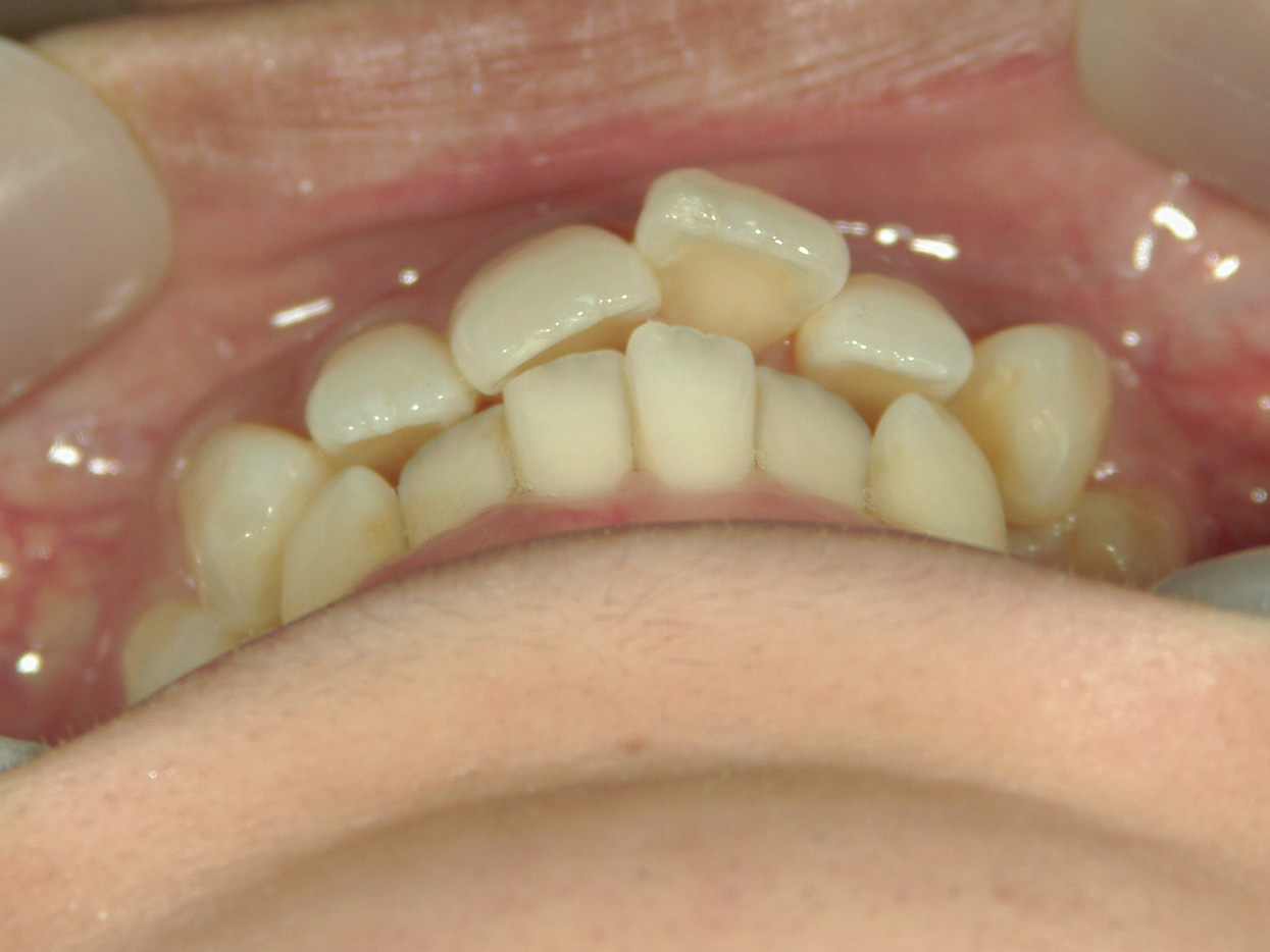 全顎ワイヤー矯正　症例（75）