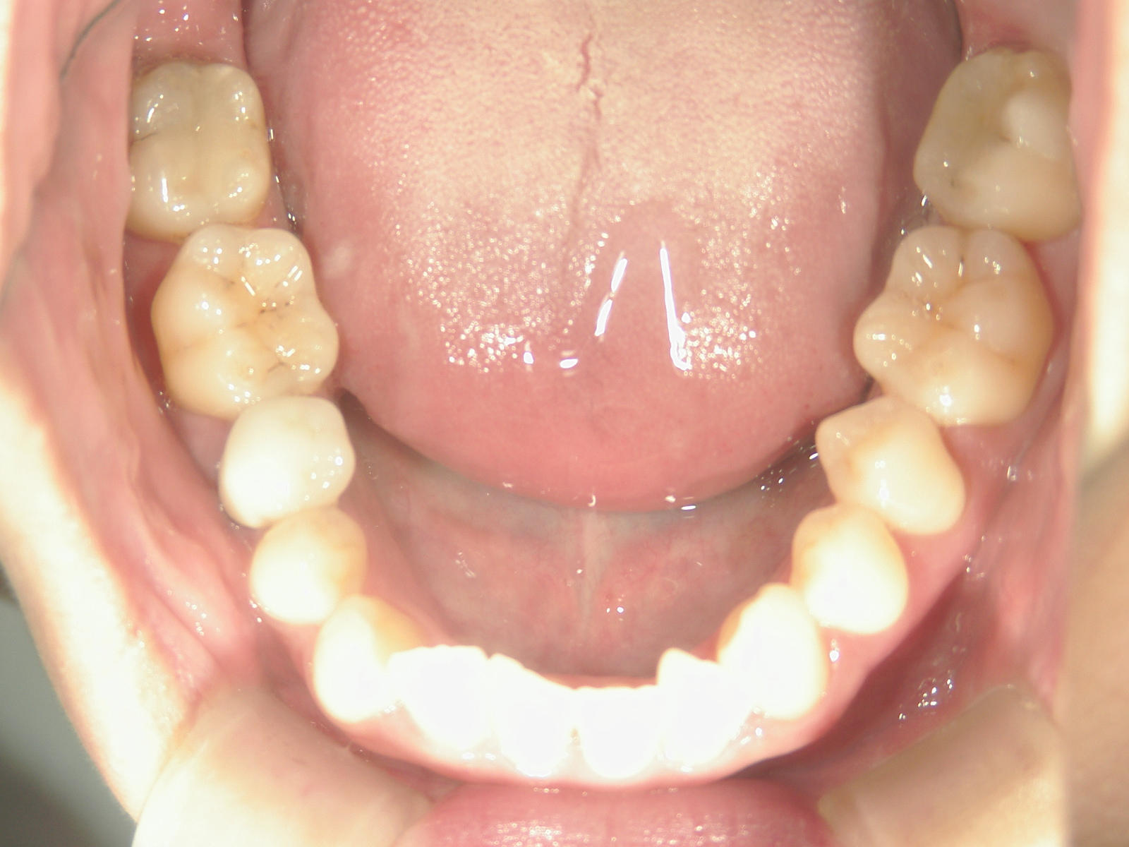 プチワイヤー矯正　症例（51）