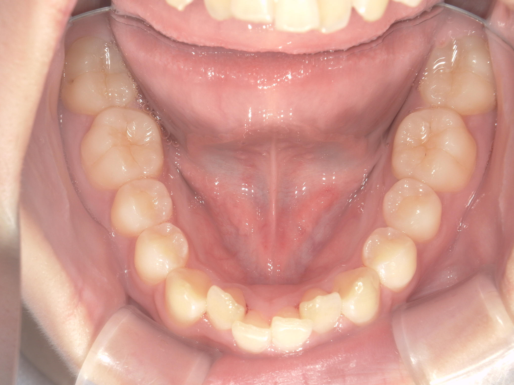 プチワイヤー矯正　症例（55）