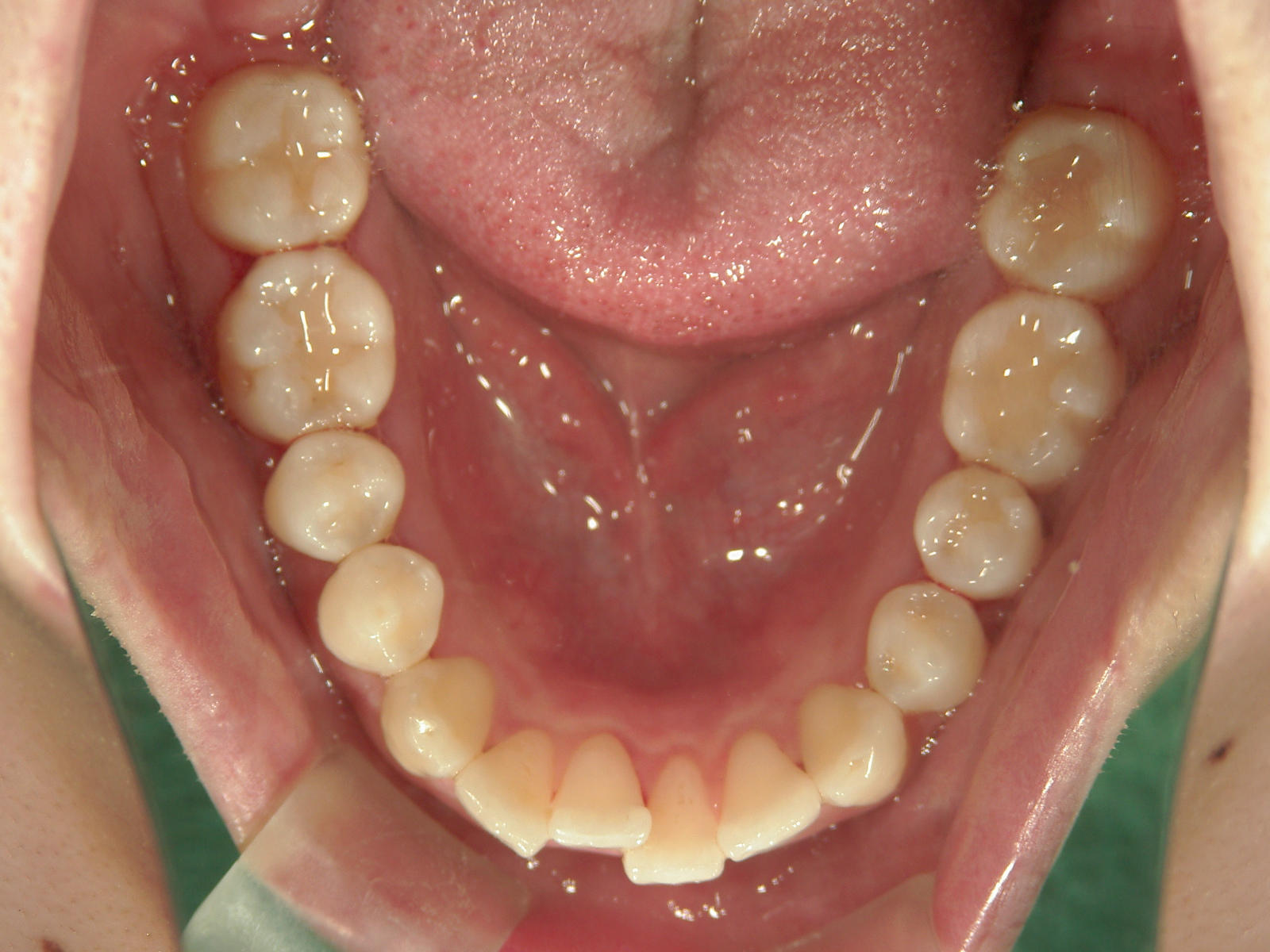 プチワイヤー矯正　症例（56）