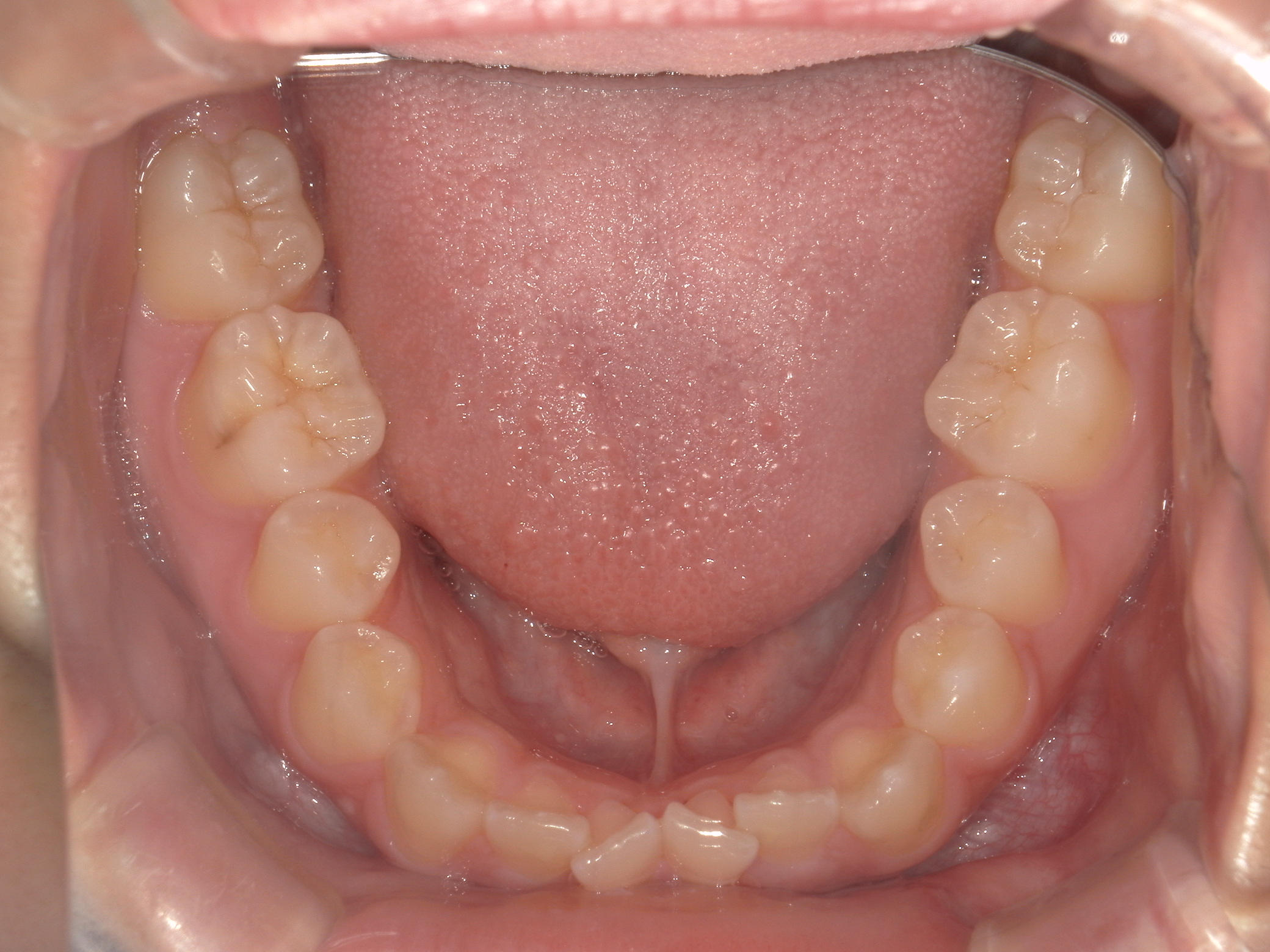 プチワイヤー矯正　症例（57）