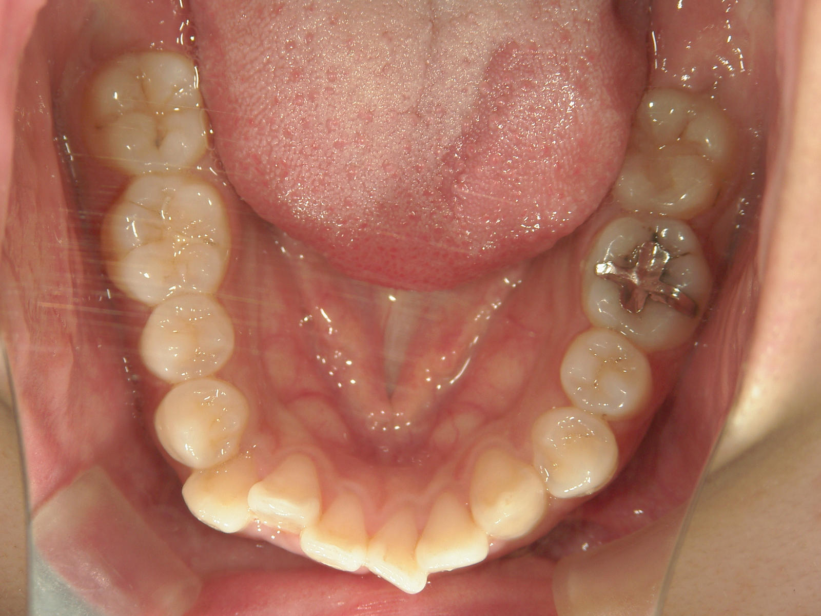 全顎ワイヤー矯正　症例（78）