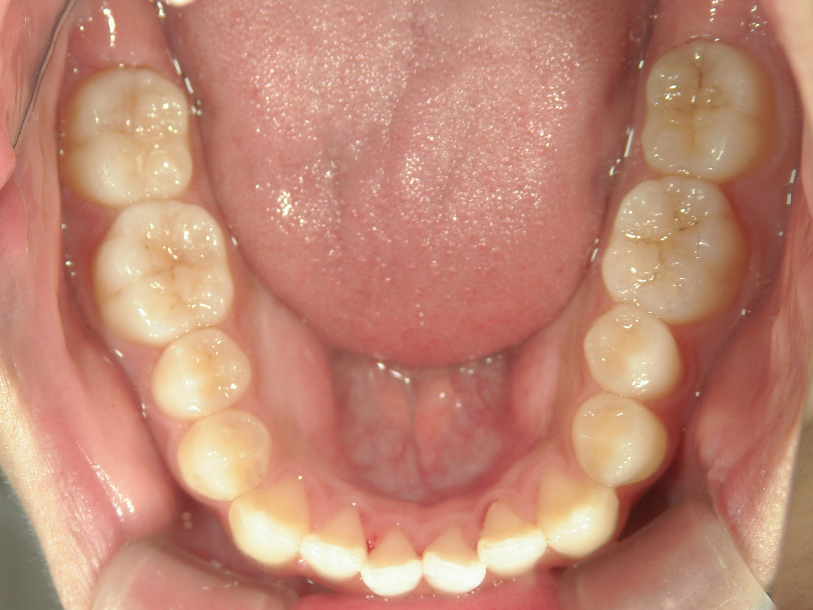 インビザライン(ライト)矯正　症例（28）