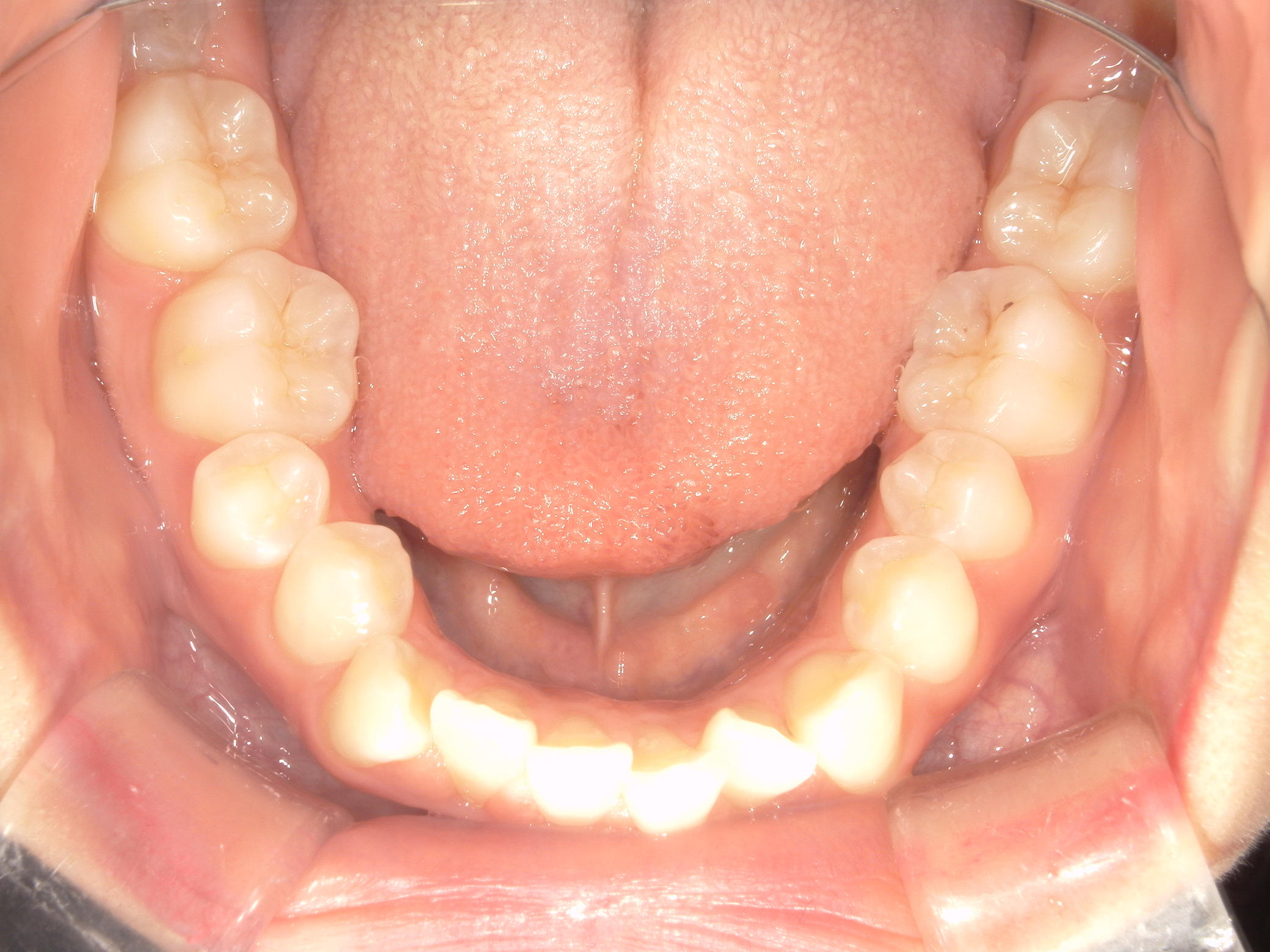 プチワイヤー矯正　症例（54）