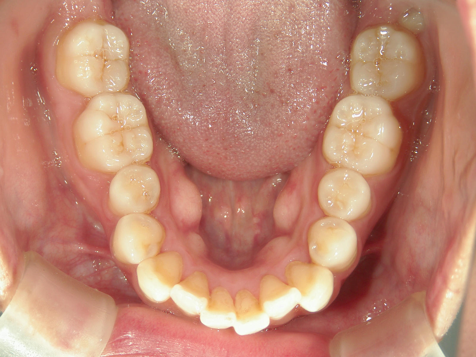 全顎ワイヤー矯正　症例（75）