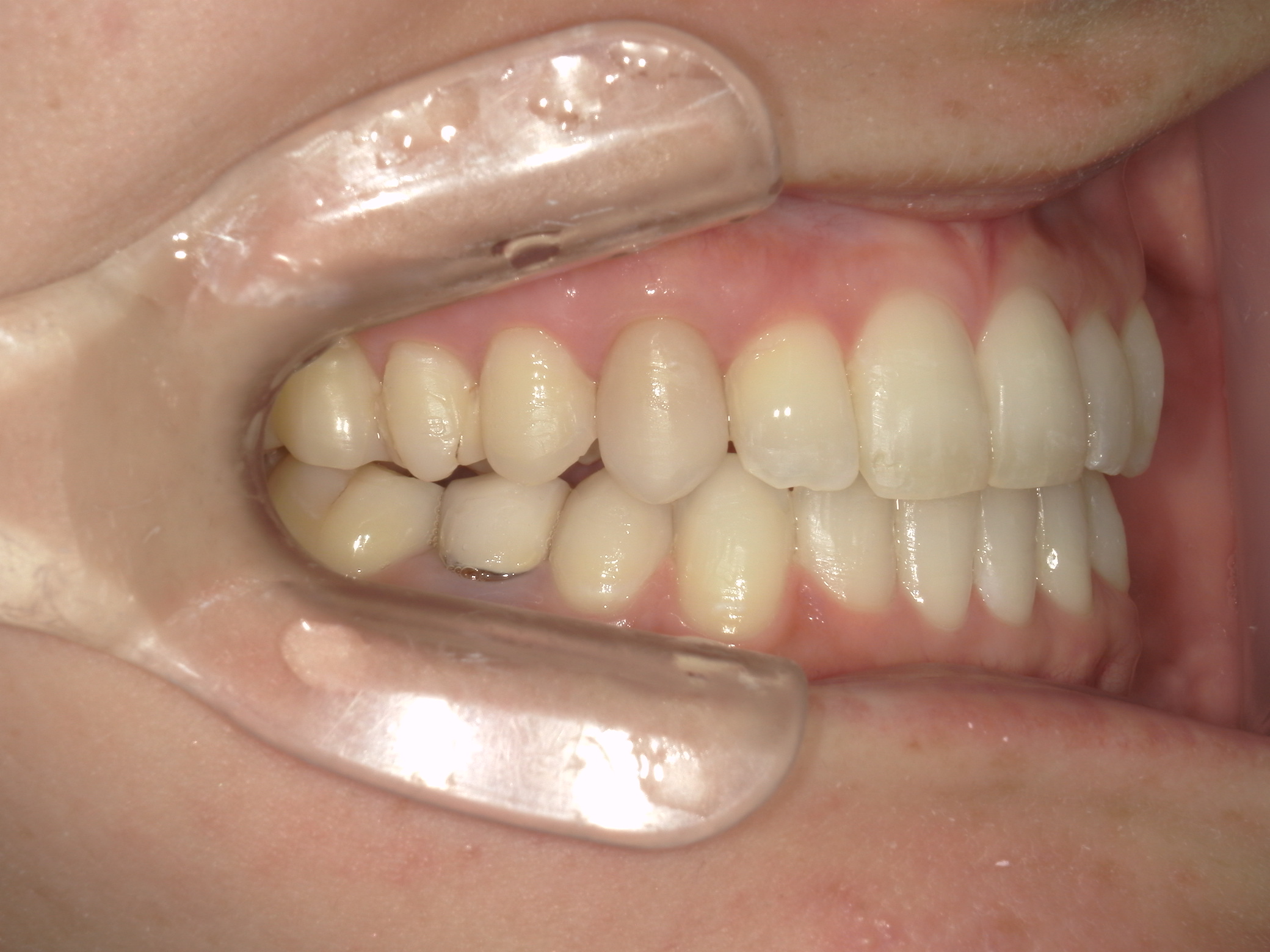 プチワイヤー矯正　症例（51）