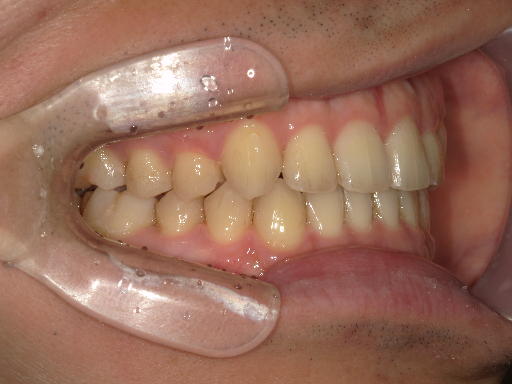 インビザライン矯正　症例（29）