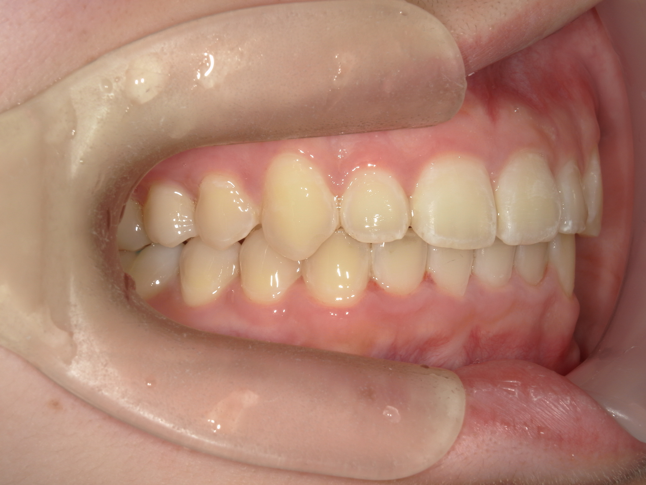 プチワイヤー矯正　症例（55）