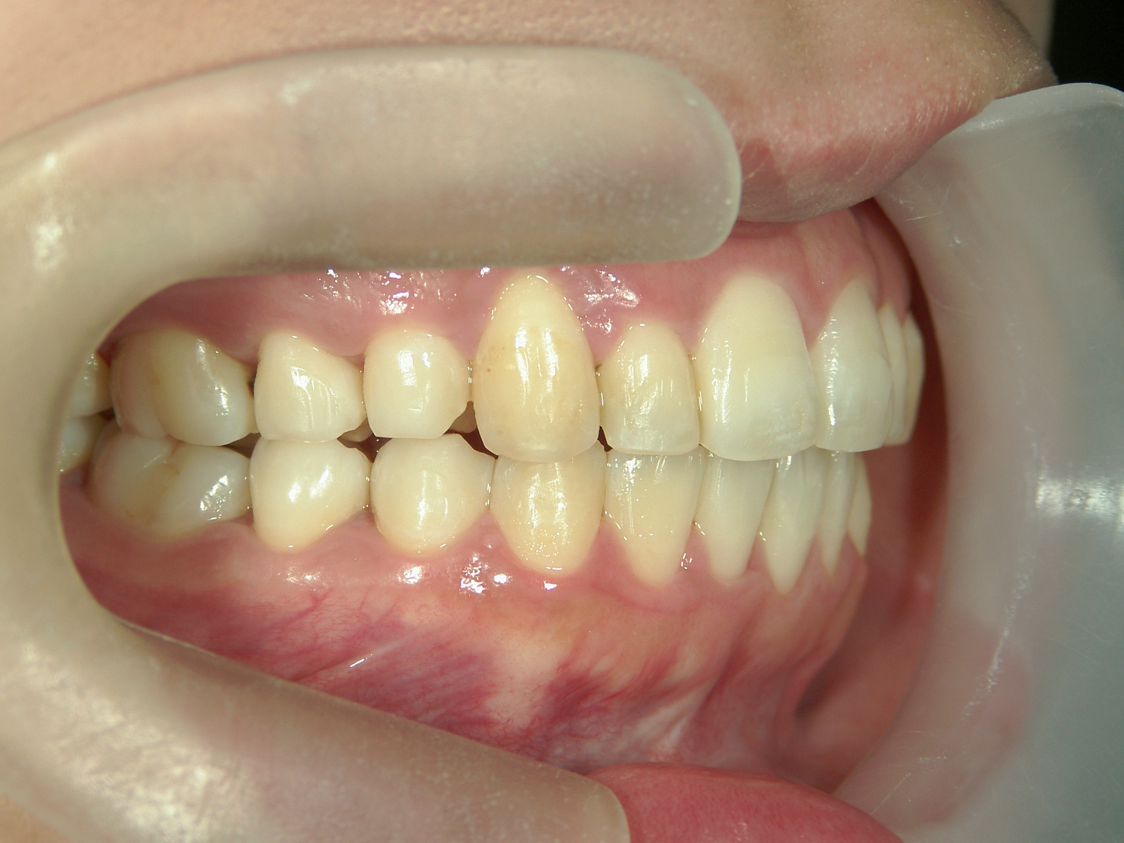 プチワイヤー矯正　症例（56）