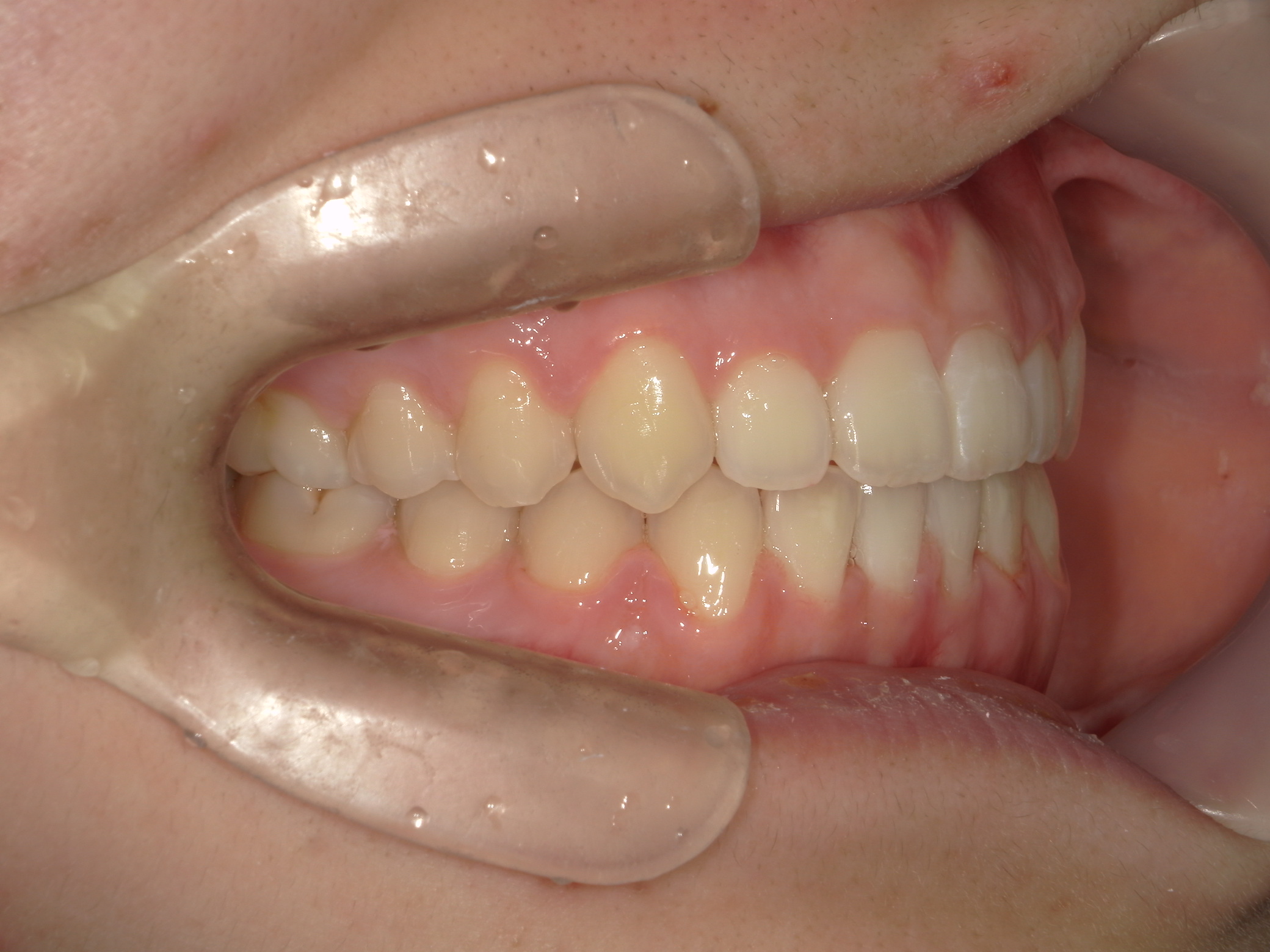 プチワイヤー矯正　症例（57）