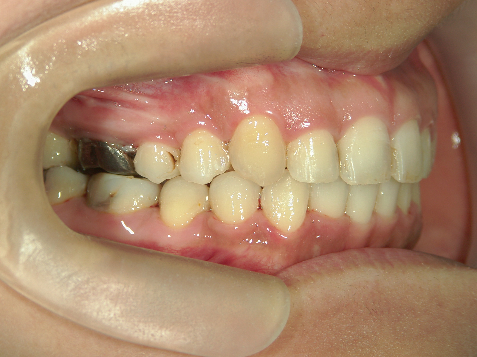 全顎ワイヤー矯正　症例（76）