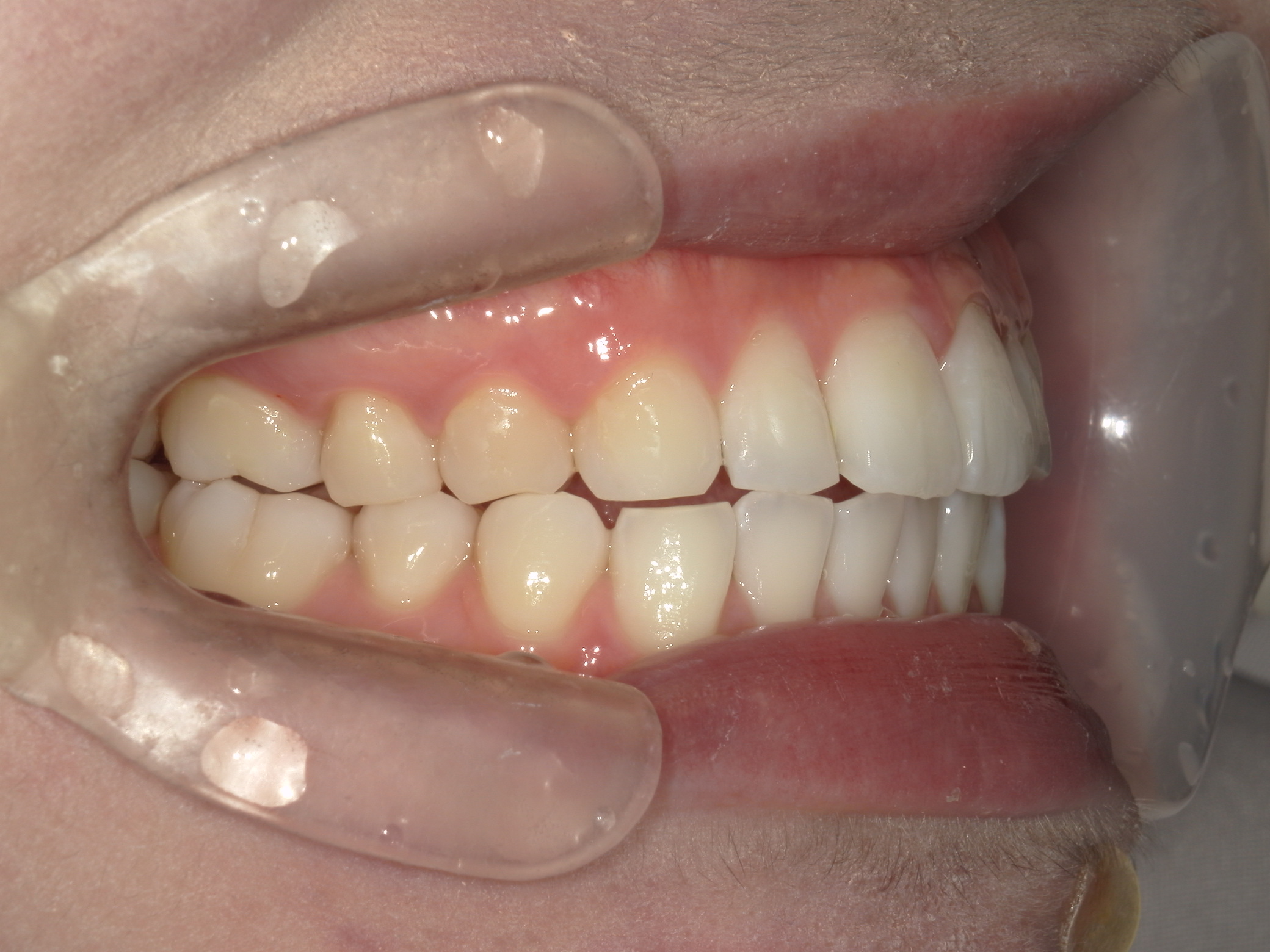 インビザライン矯正(㊤ライト)症例（27）