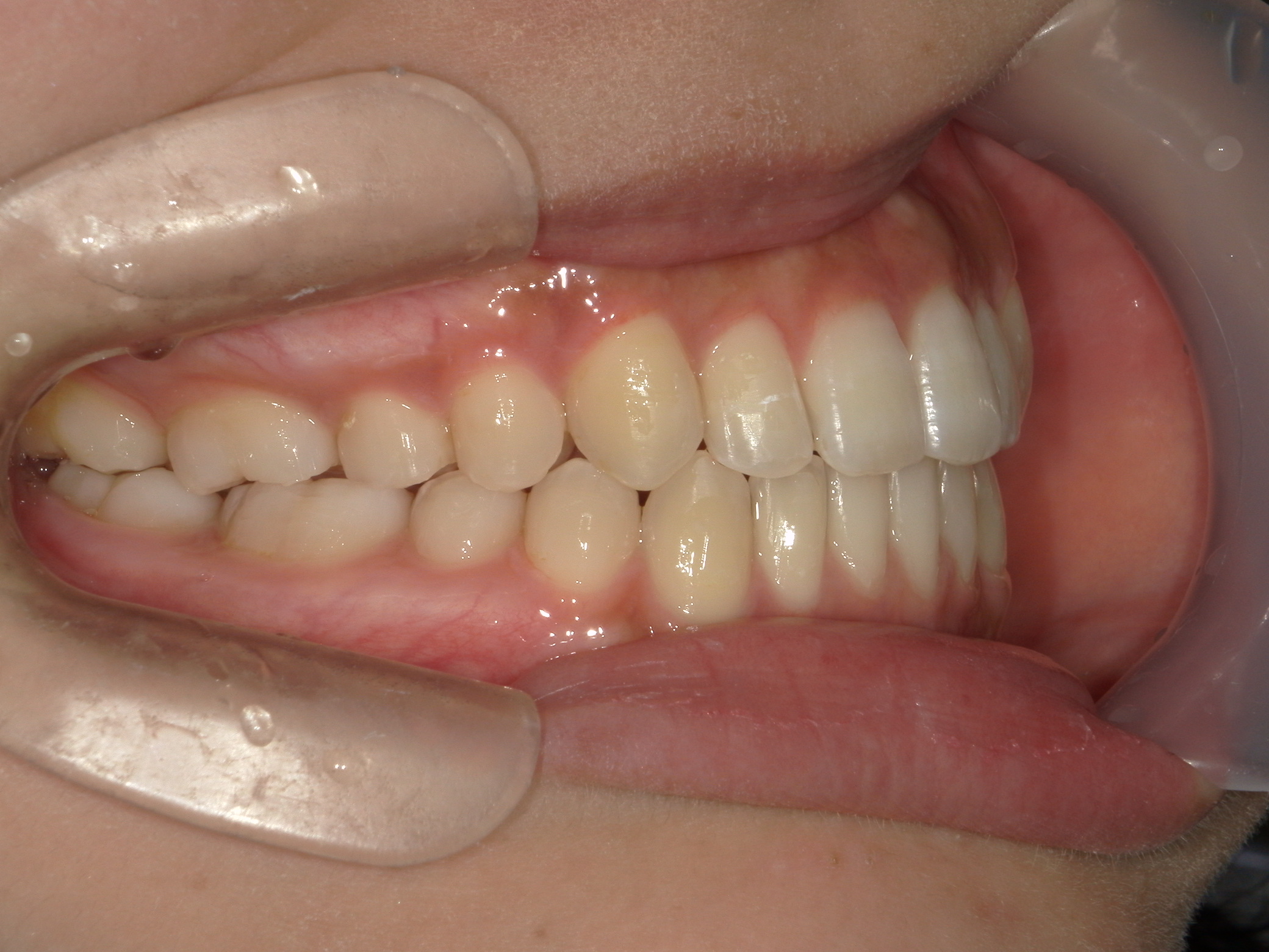 インビザライン(ライト)矯正　症例（28）