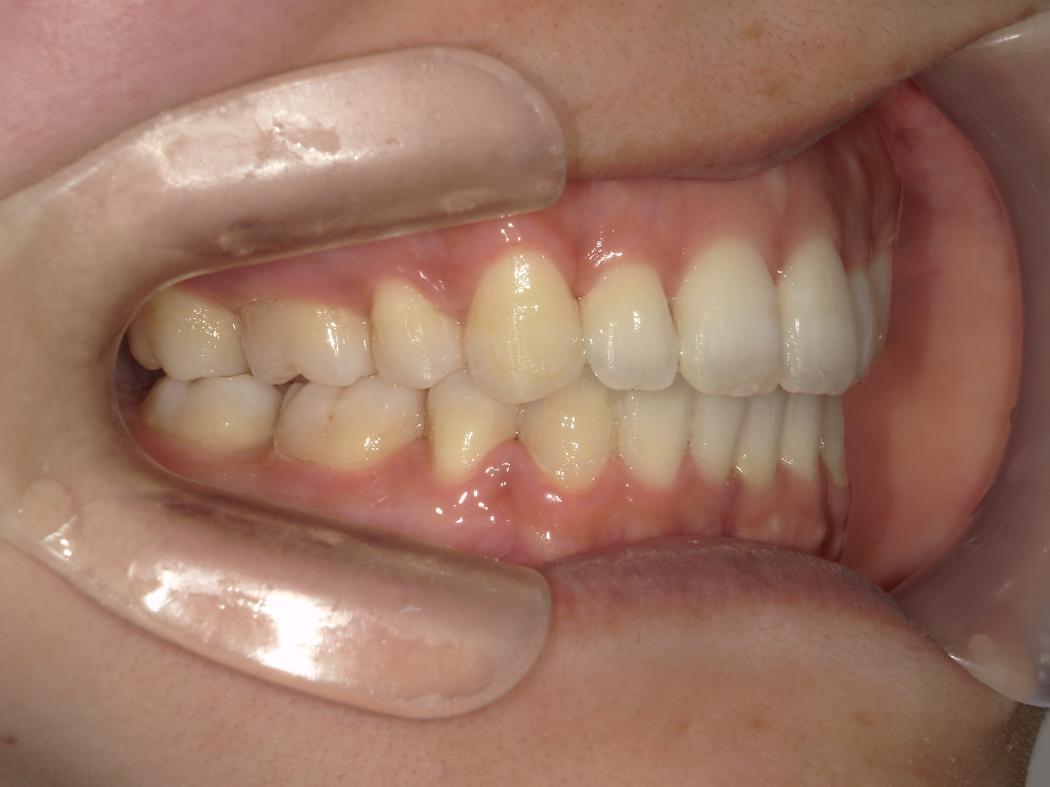 全顎ワイヤー矯正　症例（75）