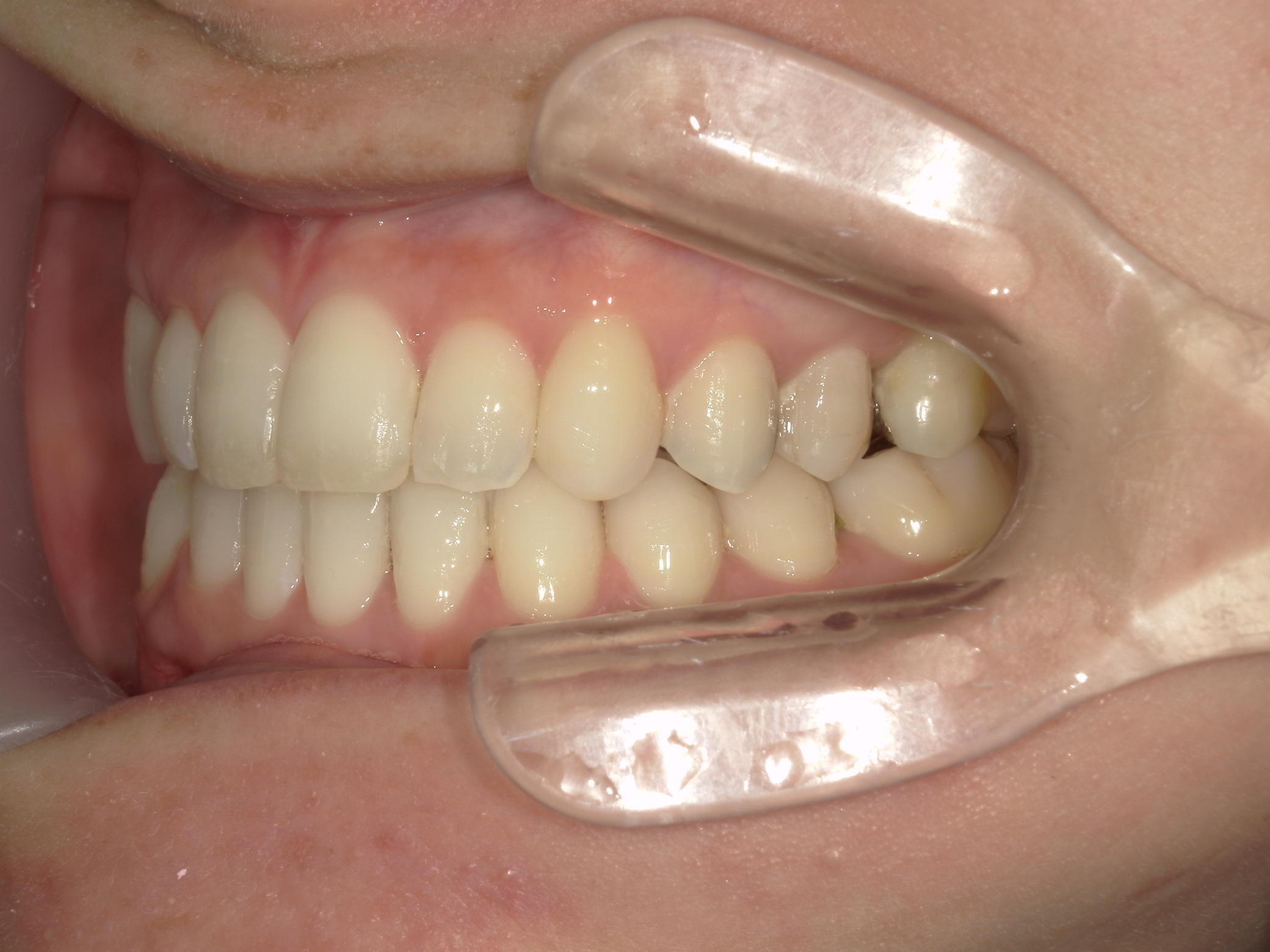 プチワイヤー矯正　症例（51）