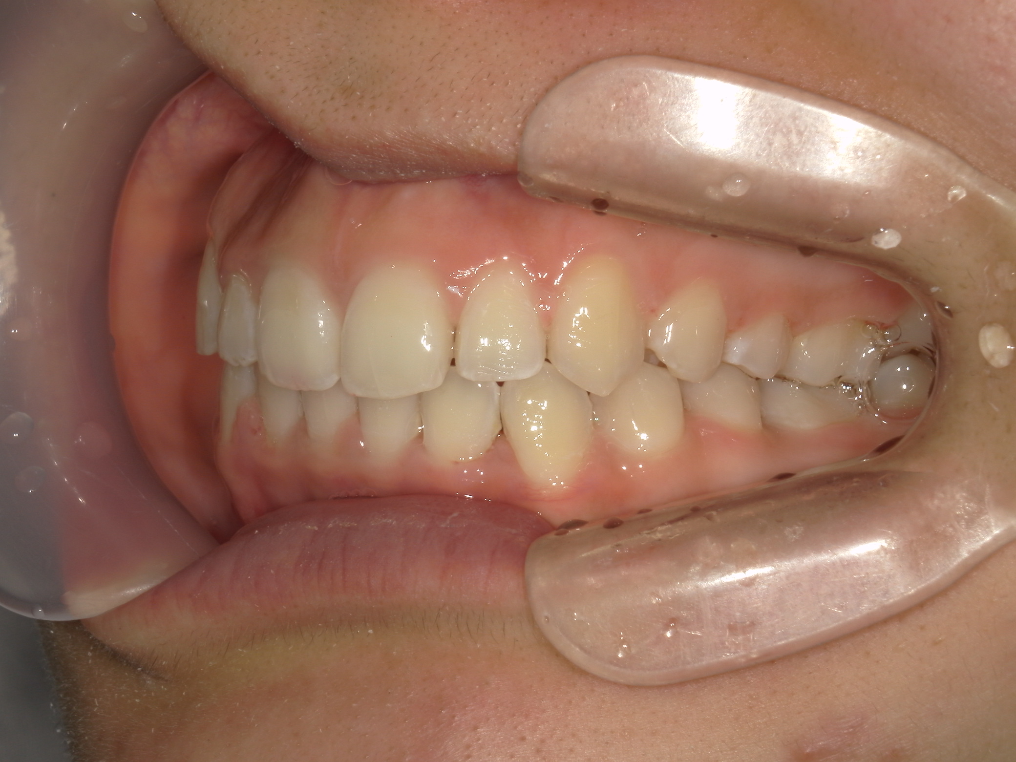 プチワイヤー矯正　症例（54）