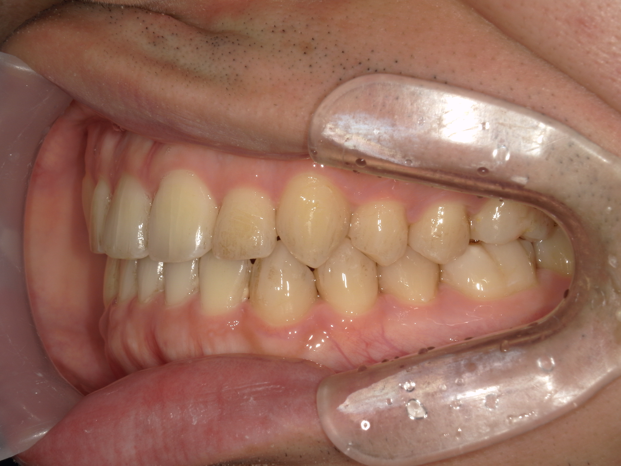 インビザライン矯正　症例（29）