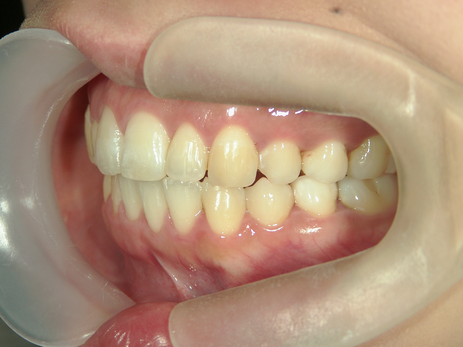 プチワイヤー矯正　症例（56）