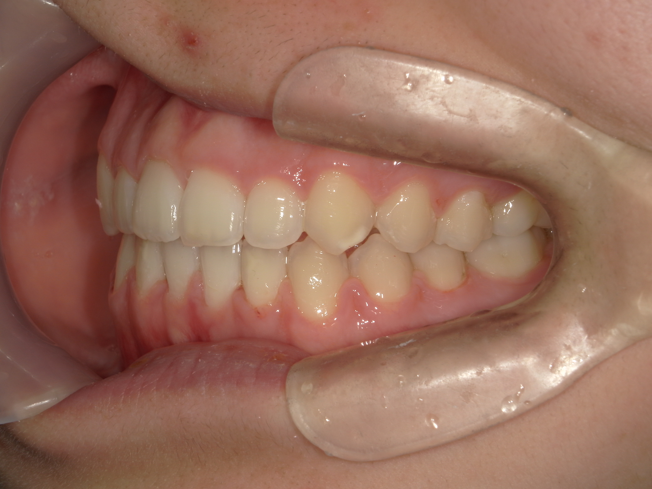 プチワイヤー矯正　症例（57）