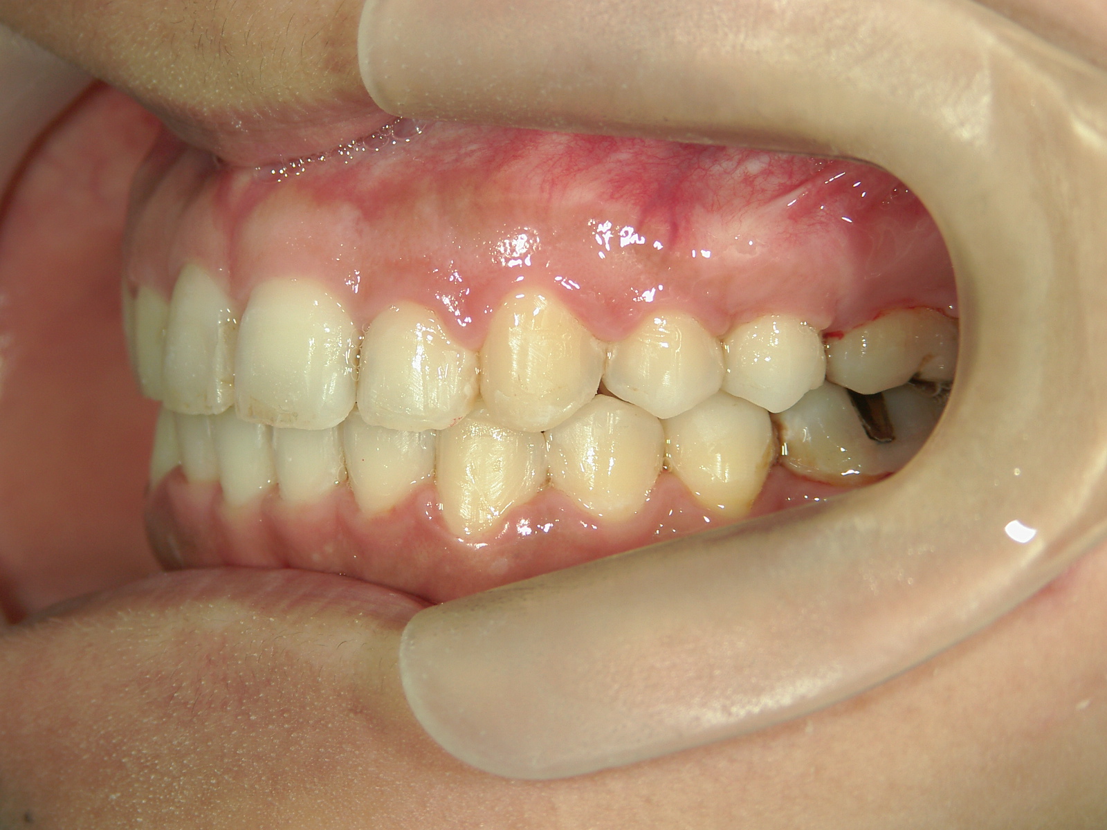 全顎ワイヤー矯正　症例（76）