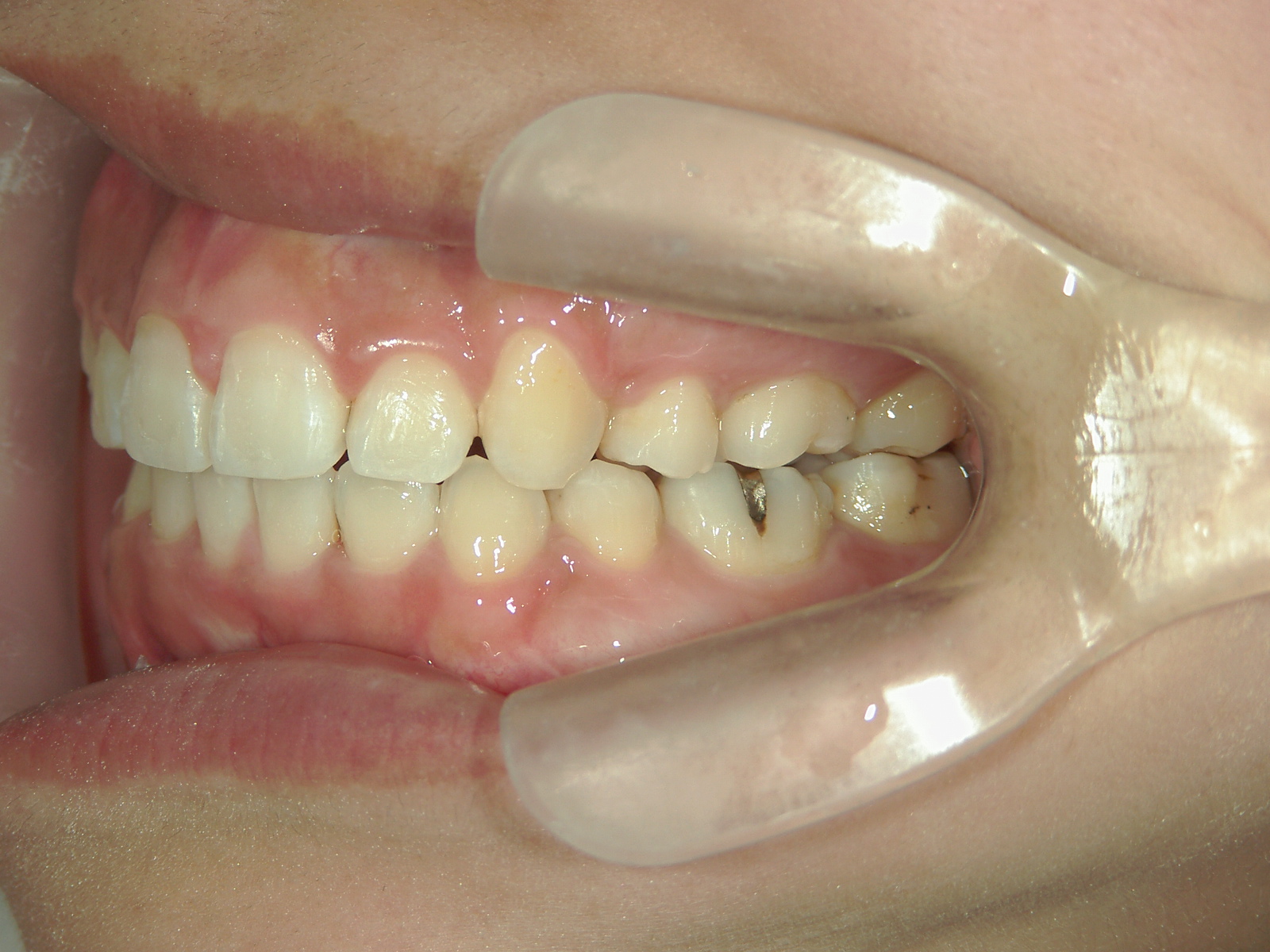 全顎ワイヤー矯正　症例（78）