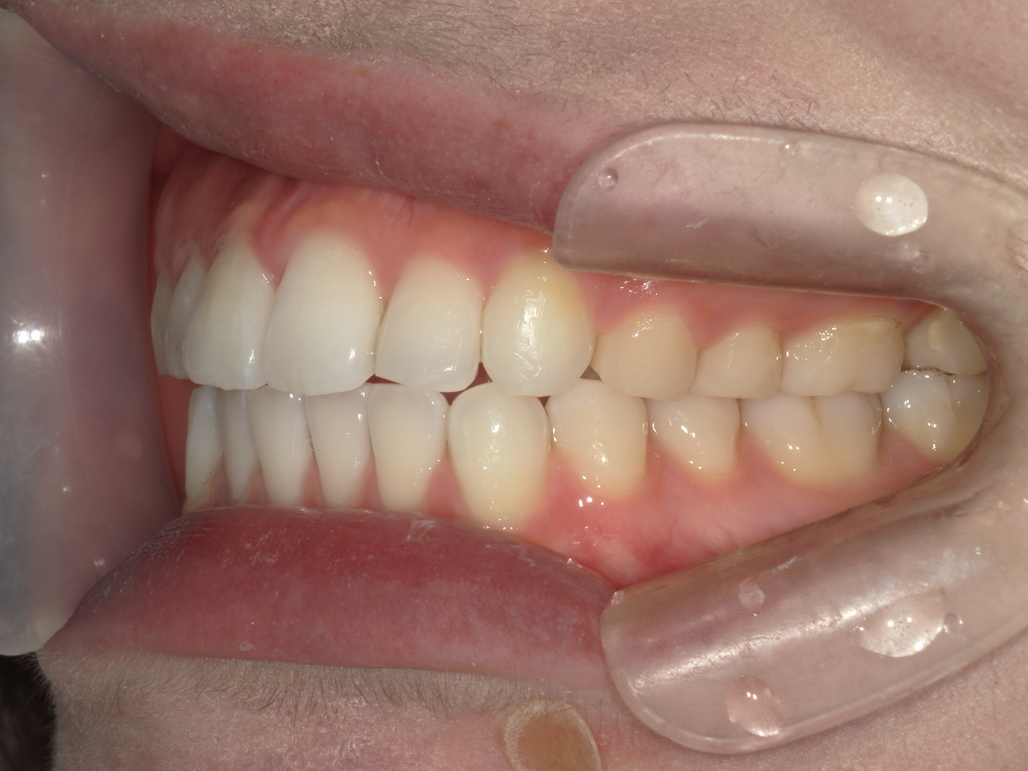 インビザライン矯正(㊤ライト)症例（27）