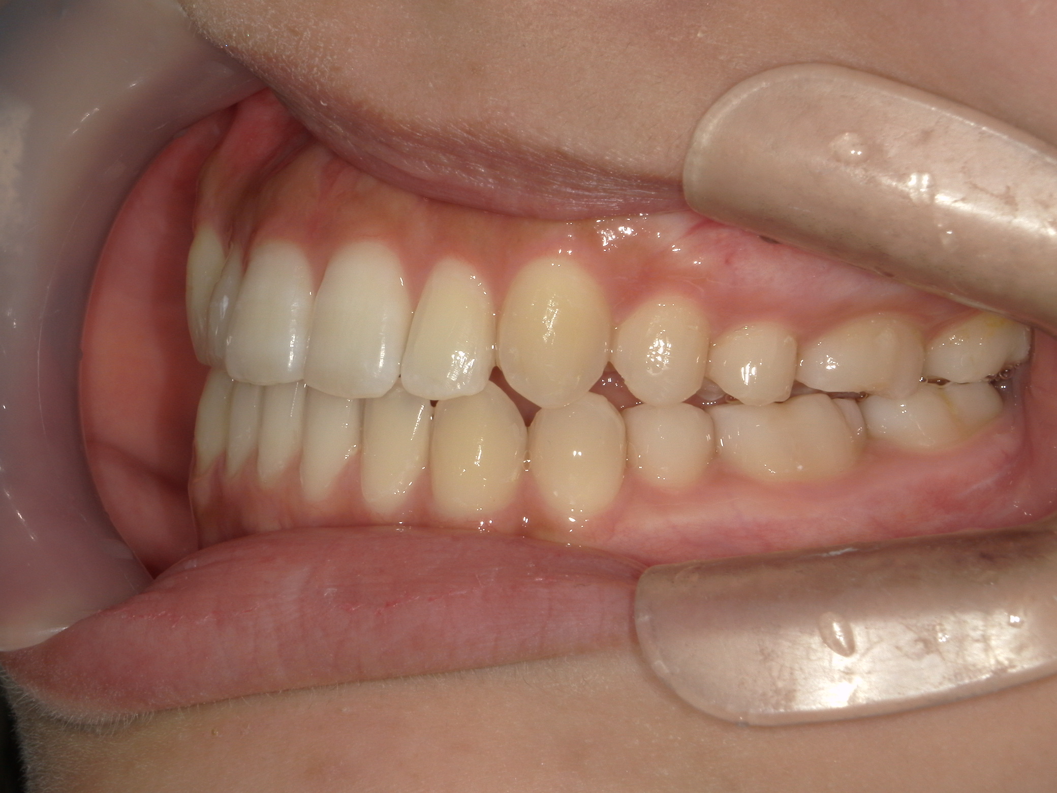 インビザライン(ライト)矯正　症例（28）