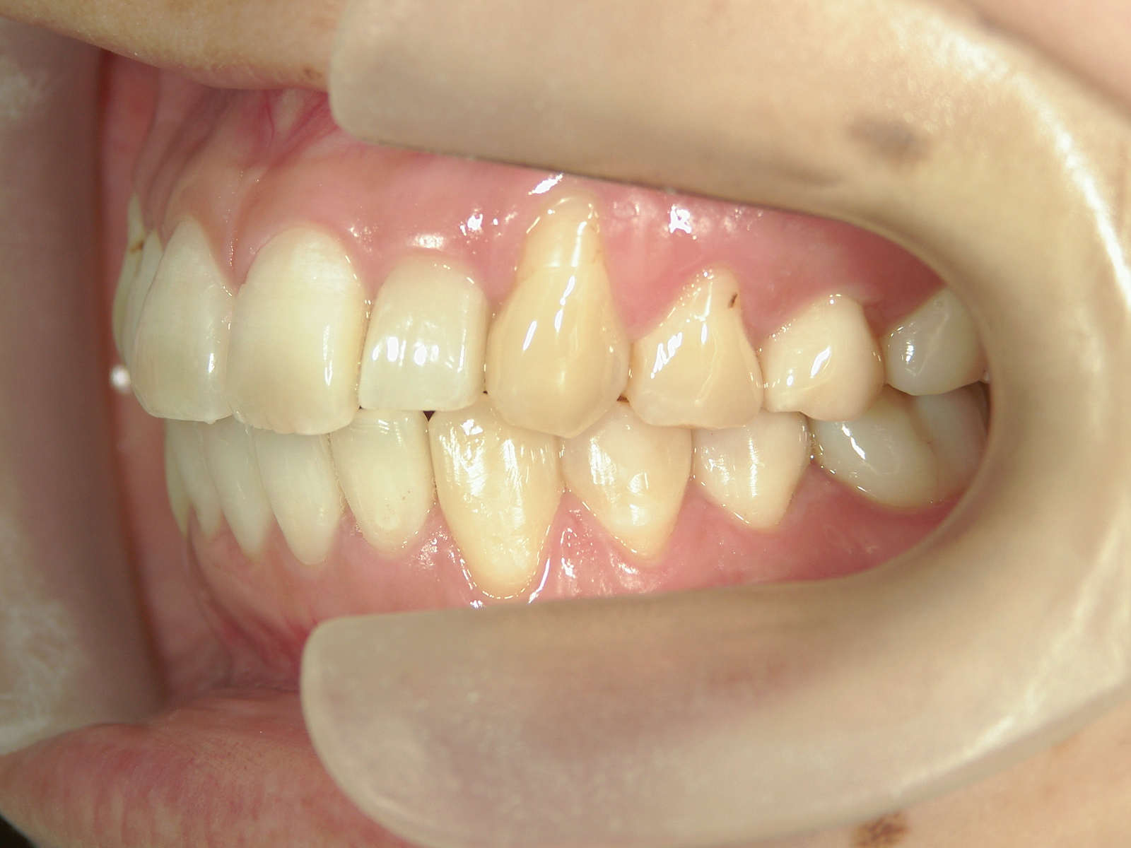 プチワイヤー矯正　症例（53）