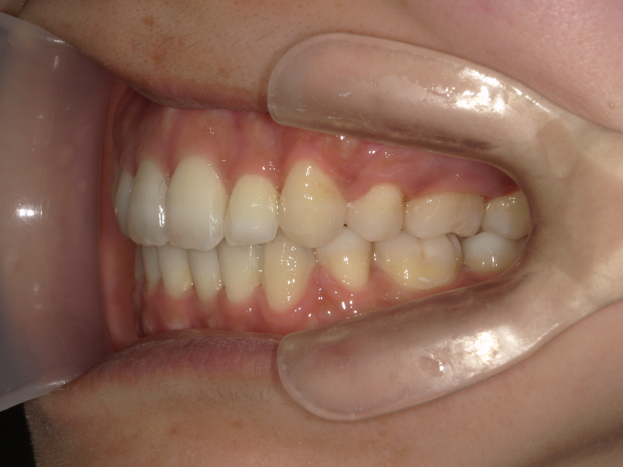 全顎ワイヤー矯正　症例（75）